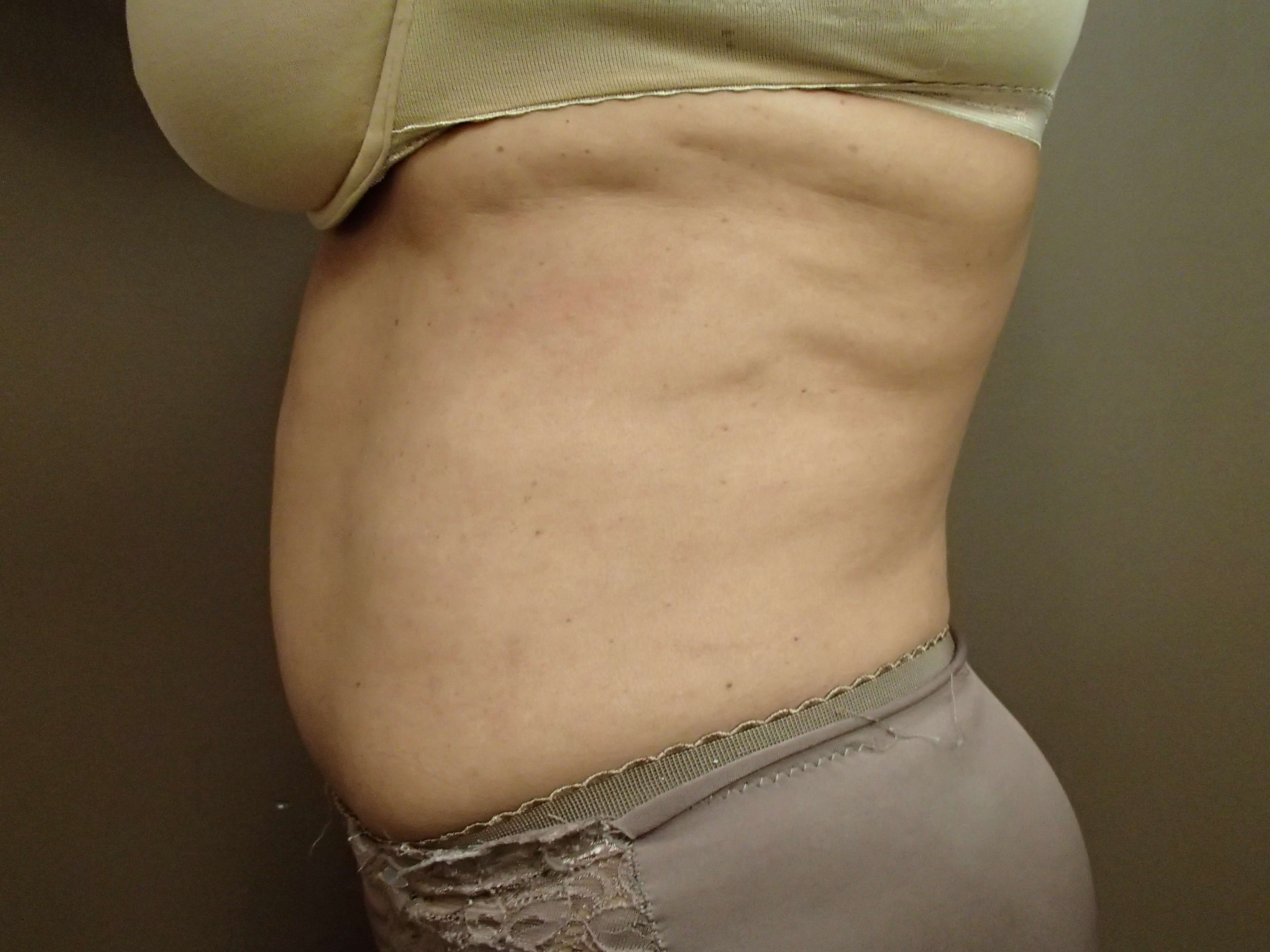 Timeless Tuck with Liposuction After