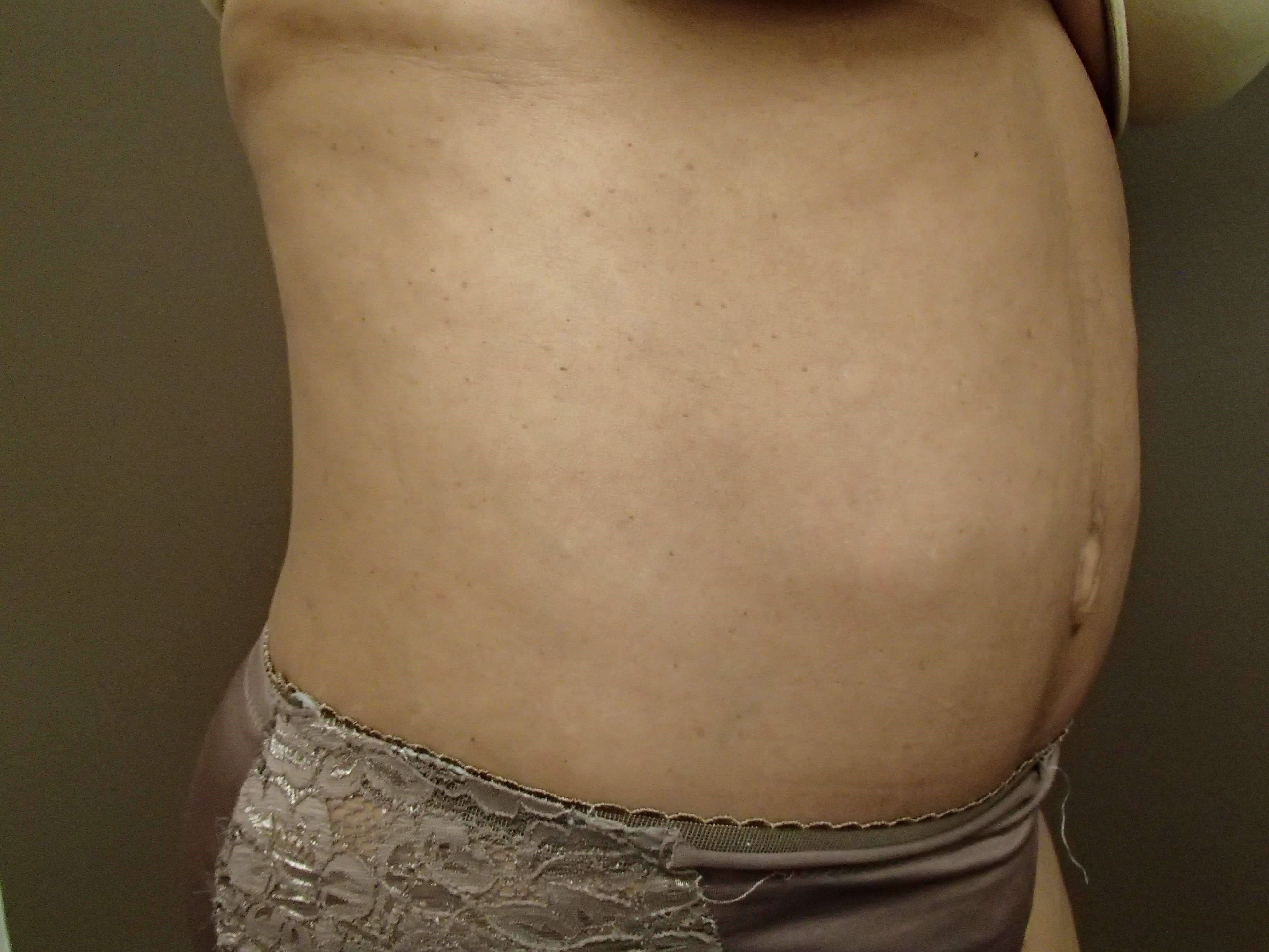 Timeless Tuck with Liposuction After