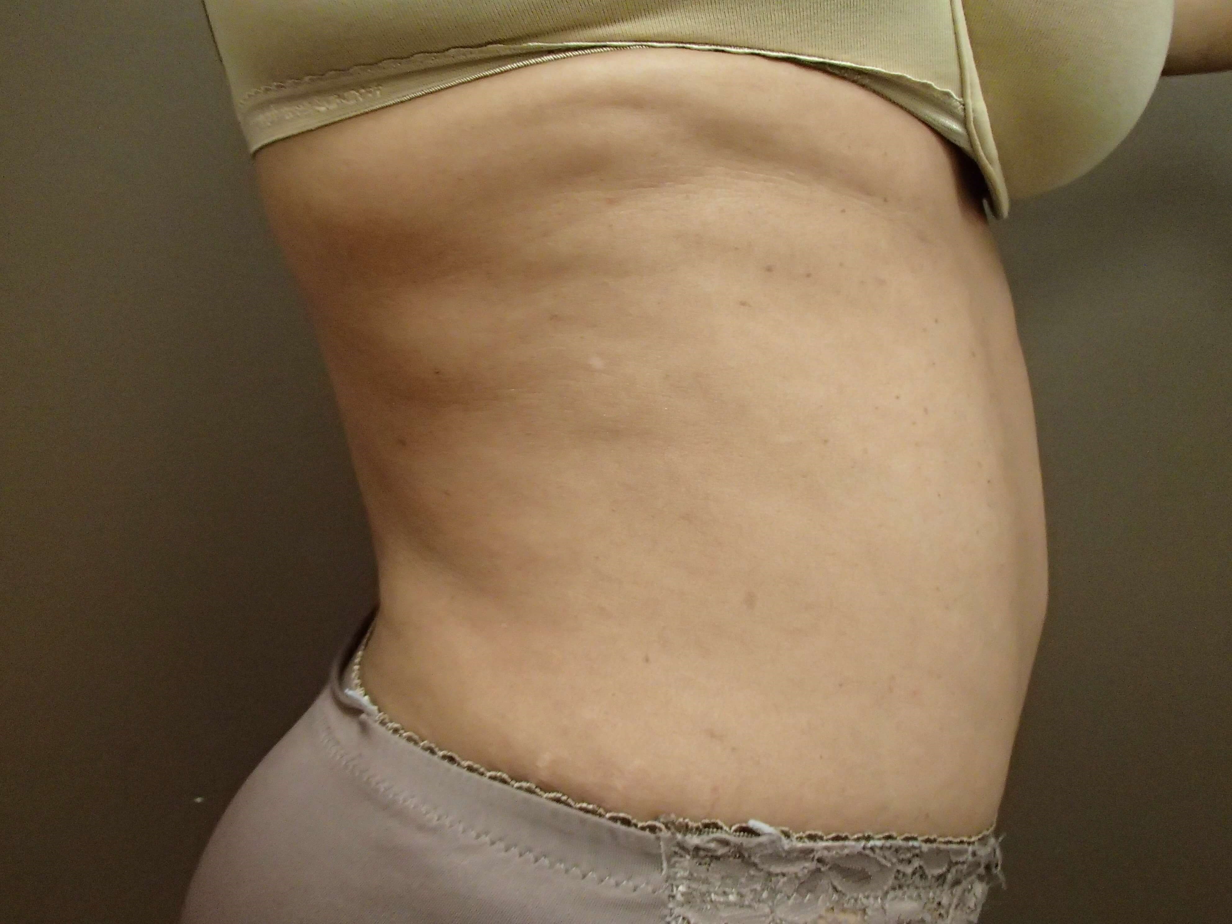 Timeless Tuck with Liposuction After