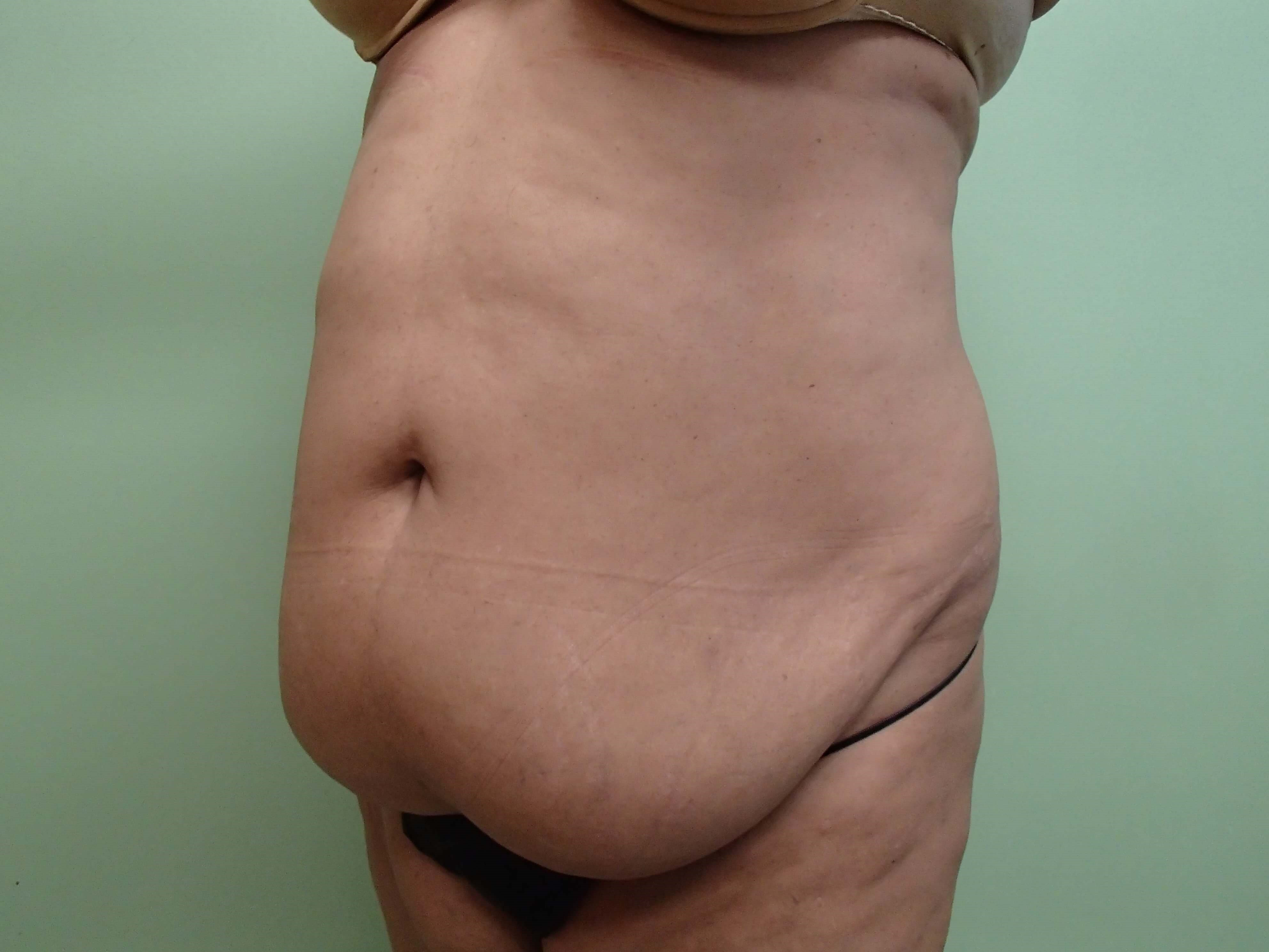 Timeless Tuck with Liposuction Before
