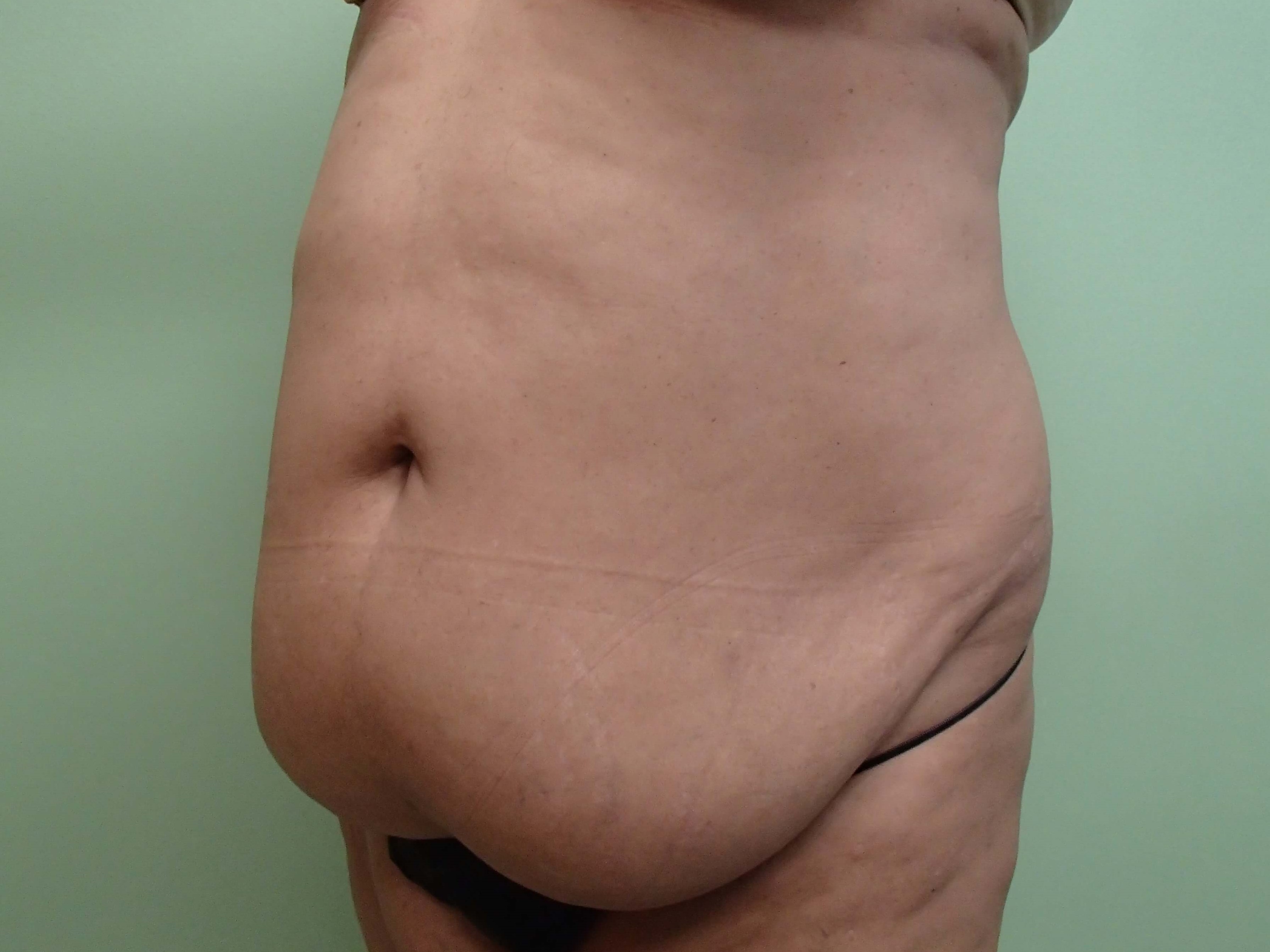 Timeless Tuck with Liposuction Before