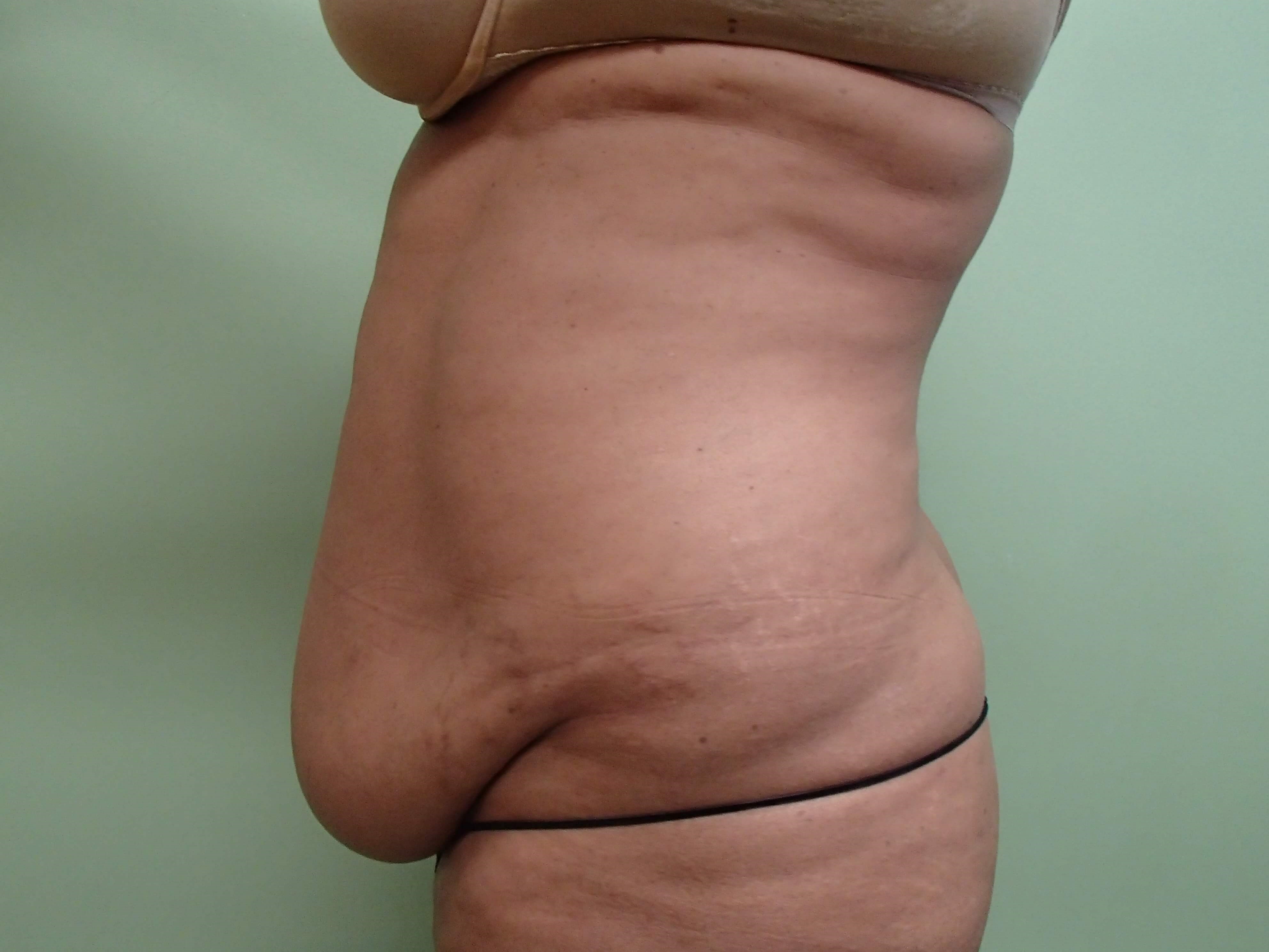 Timeless Tuck with Liposuction Before