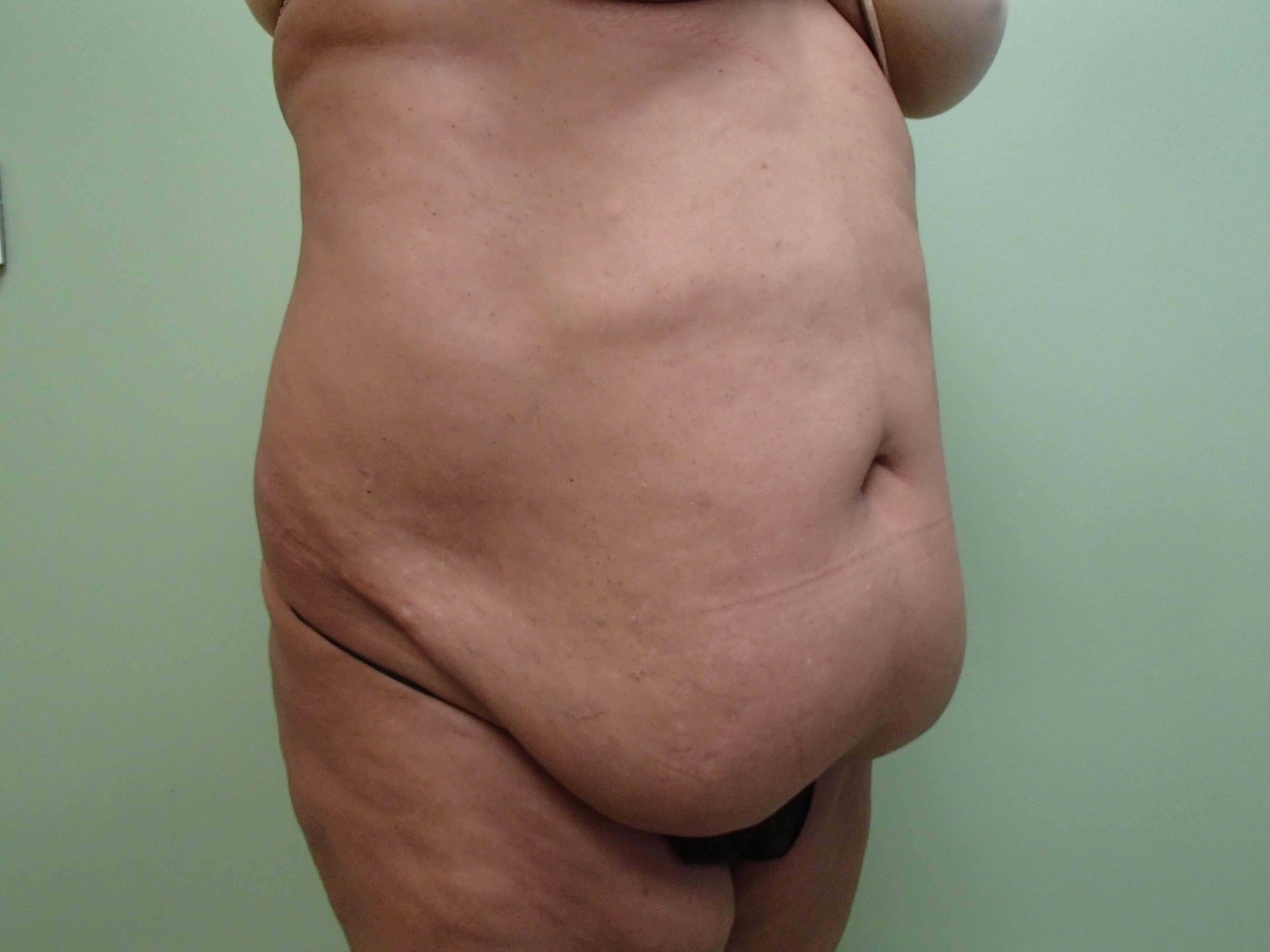 Timeless Tuck with Liposuction Before