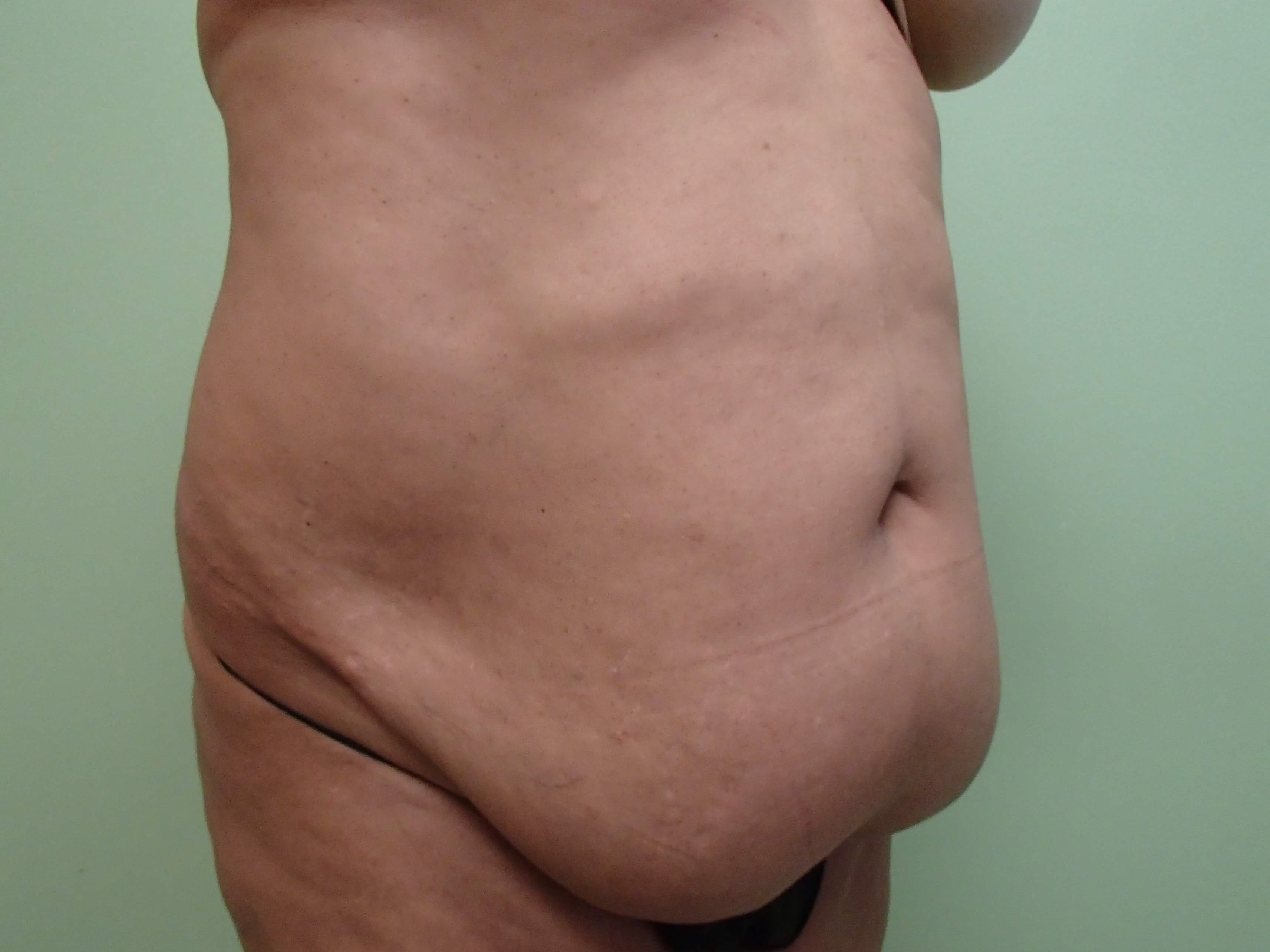 Timeless Tuck with Liposuction Before