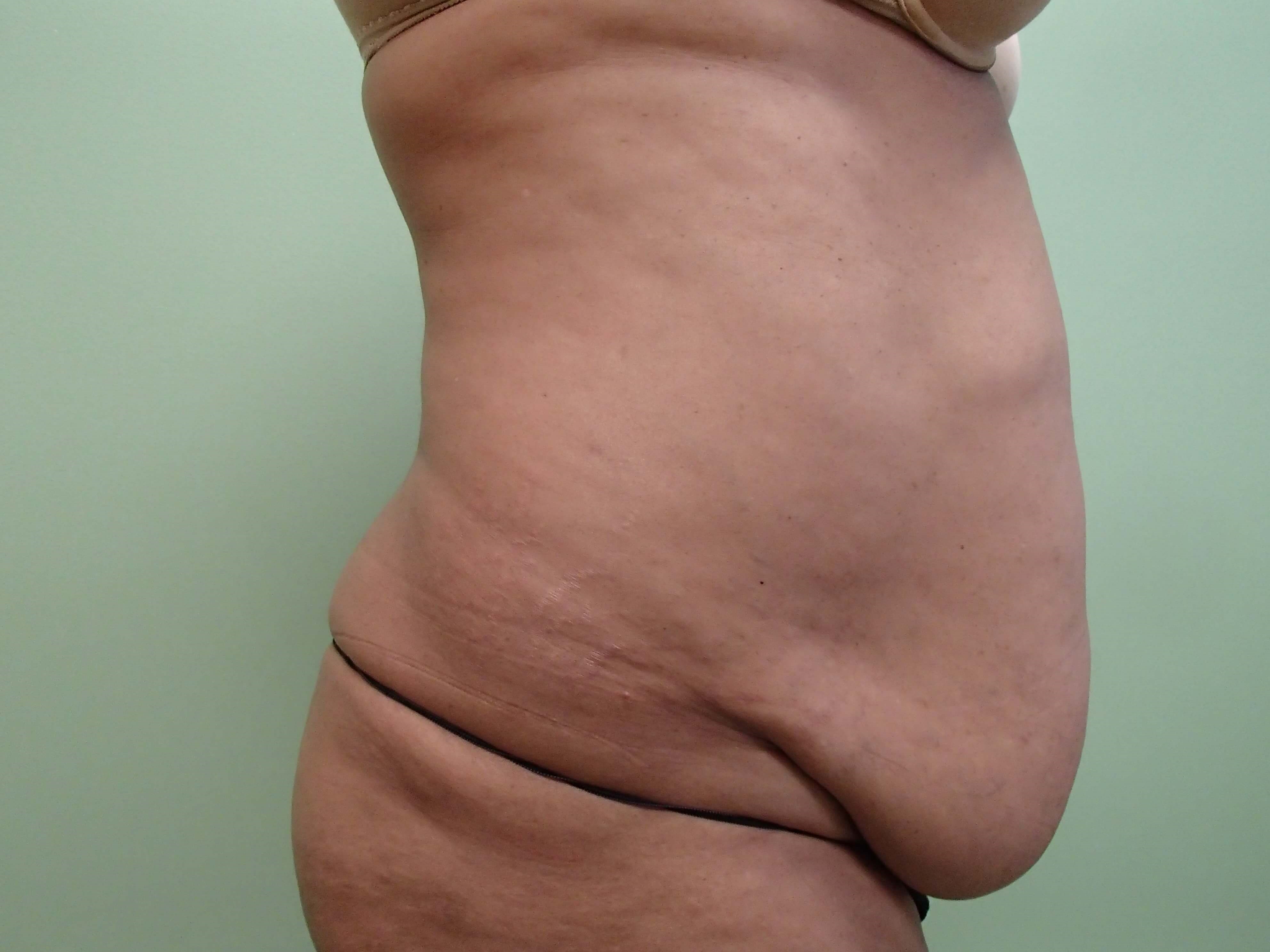 Timeless Tuck with Liposuction Before