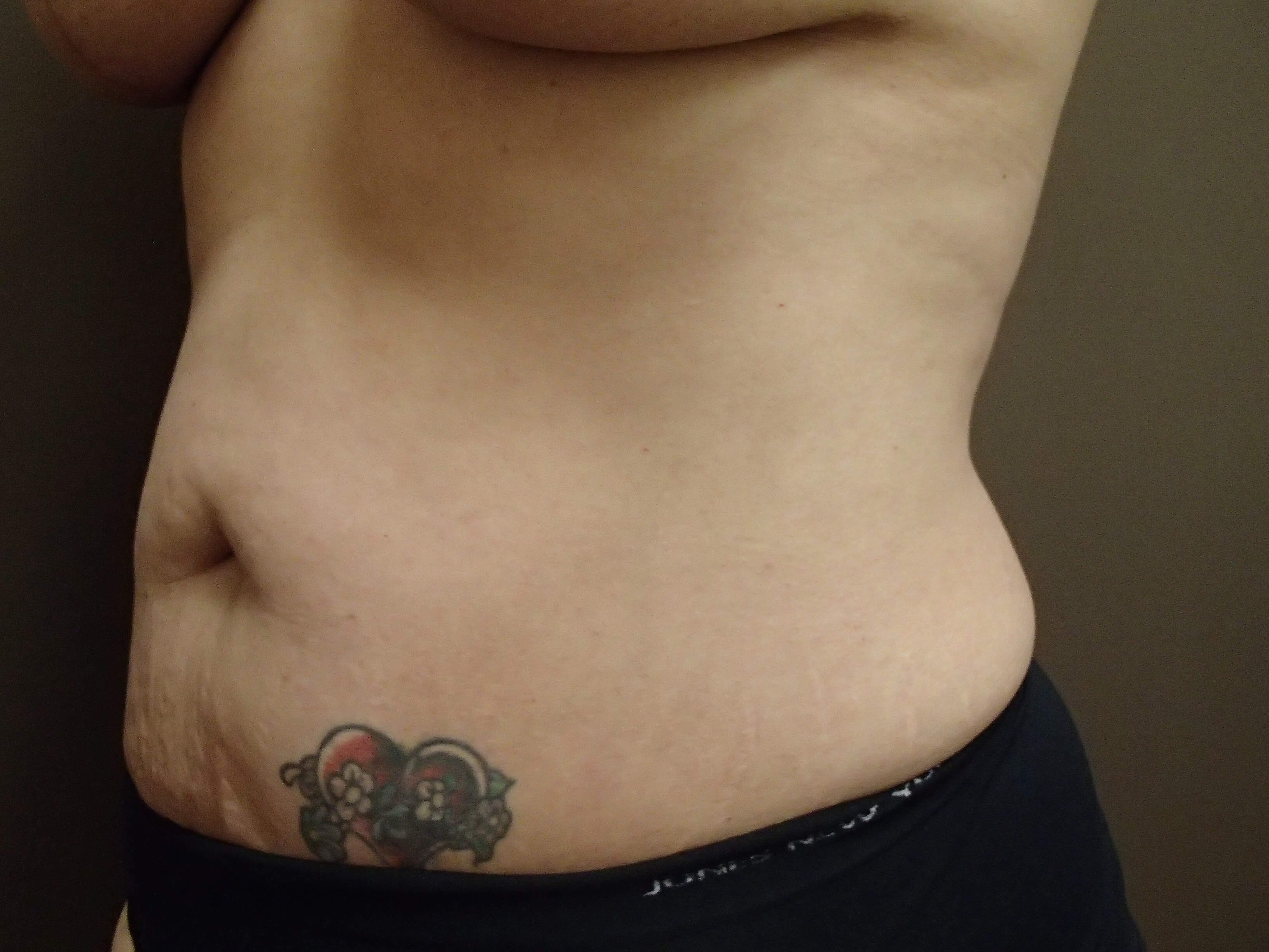 Abdominoplasty and Liposuction Before