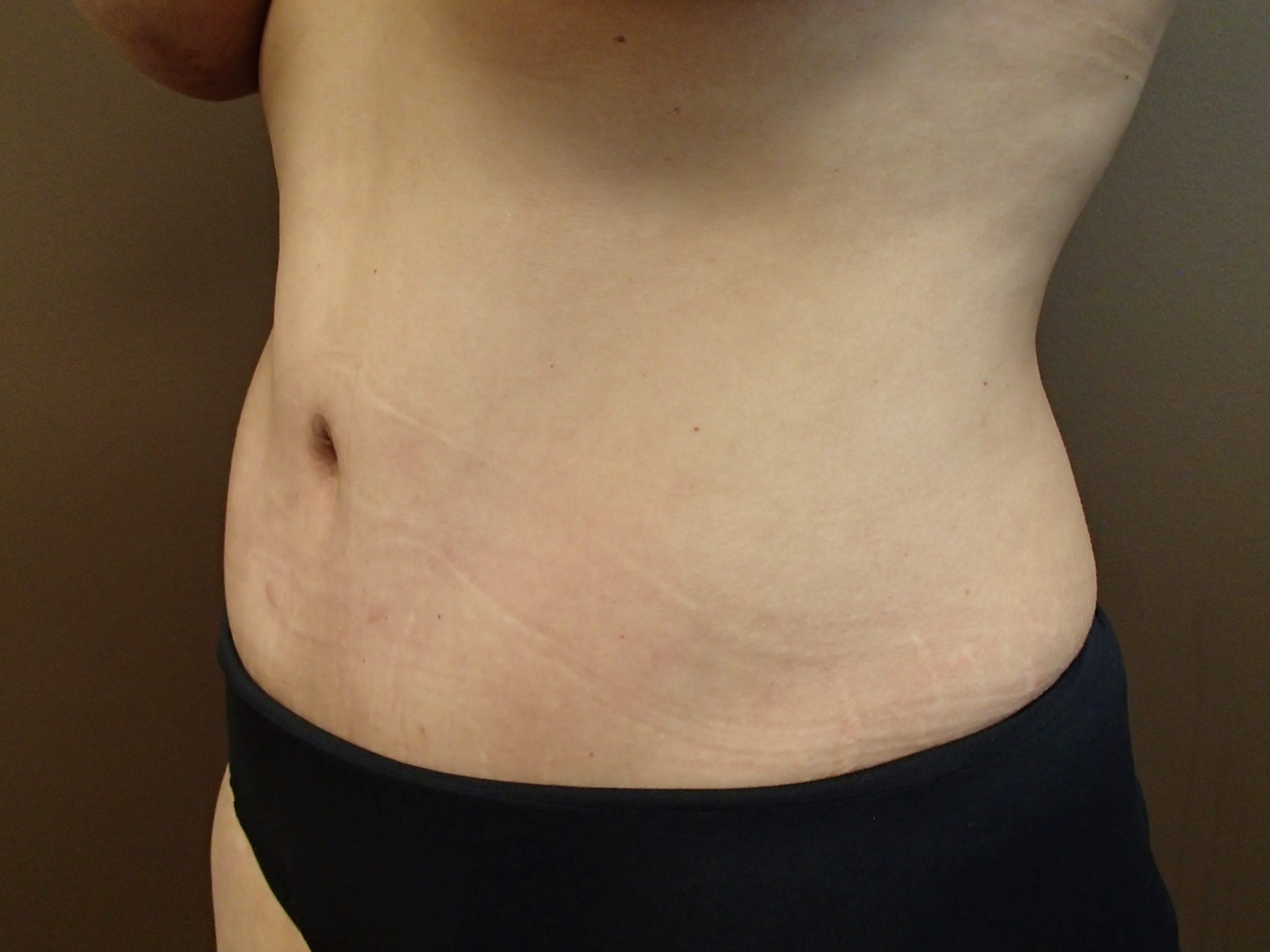 Abdominoplasty and Liposuction After