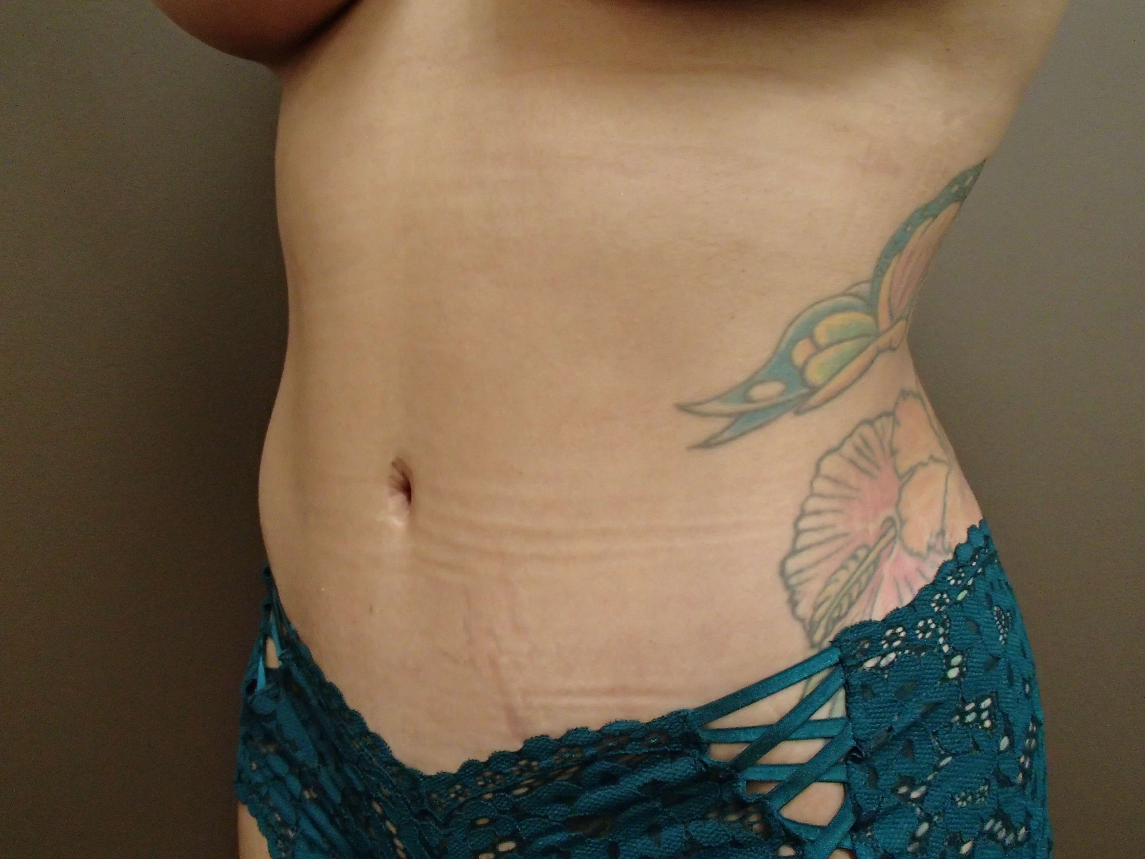 Timeless Tuck Oblique View After