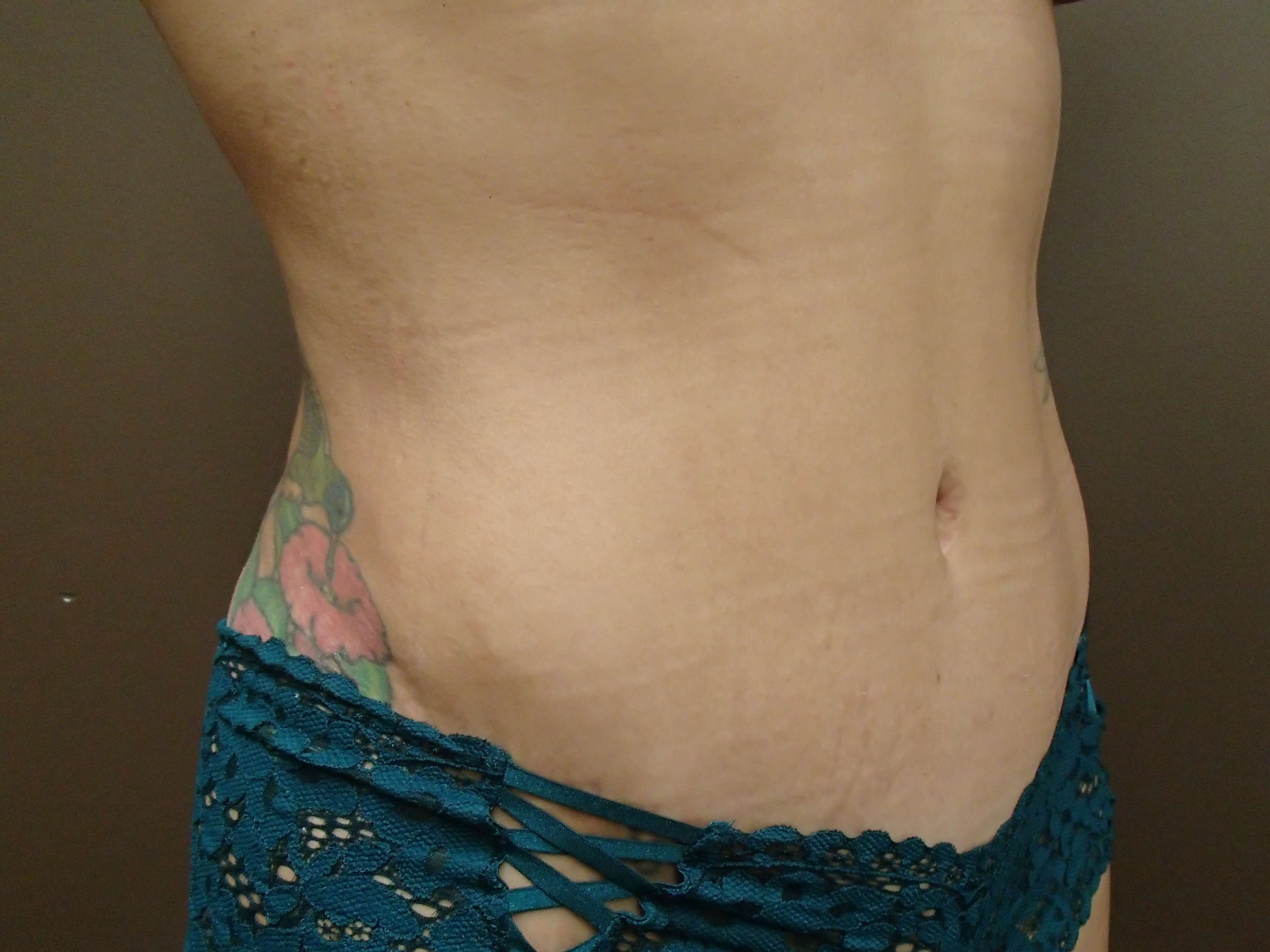 Timeless Tuck Oblique View After