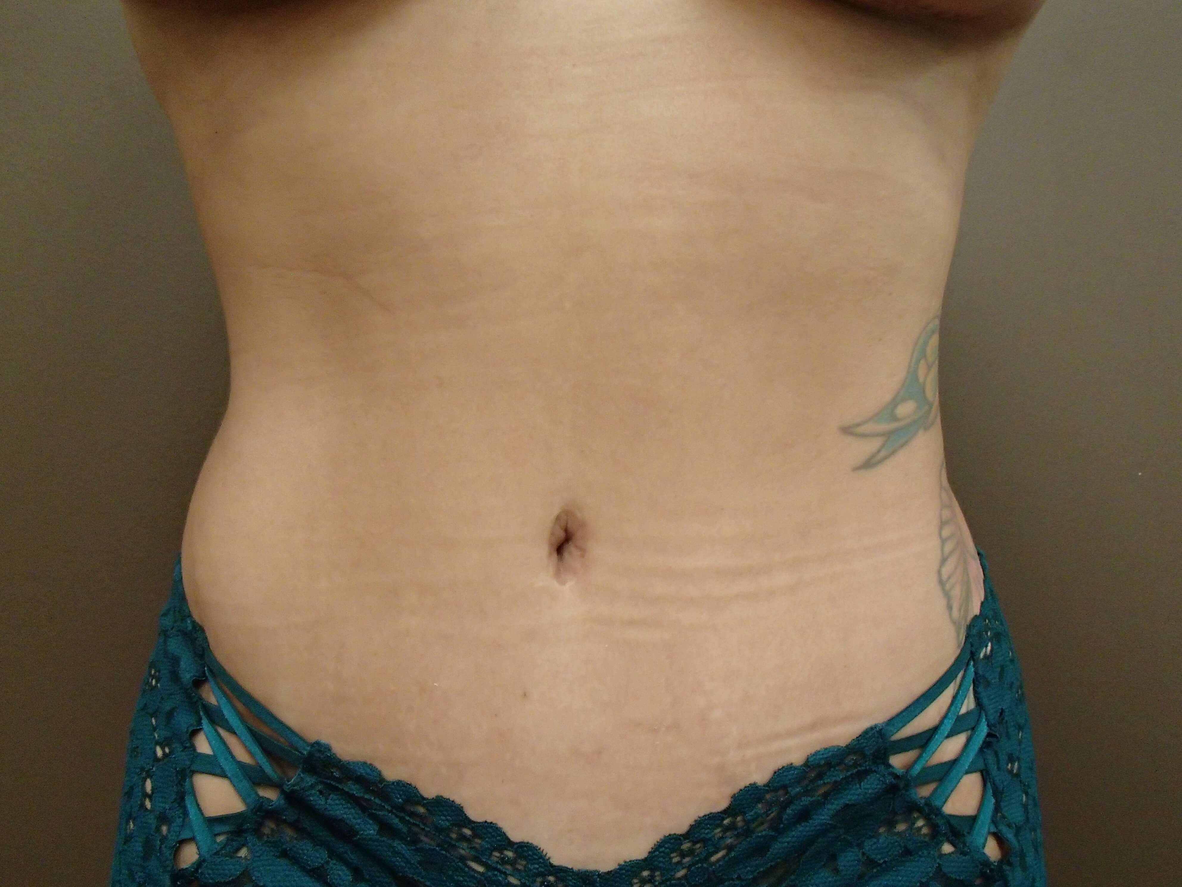 Timeless Tuck Front View After