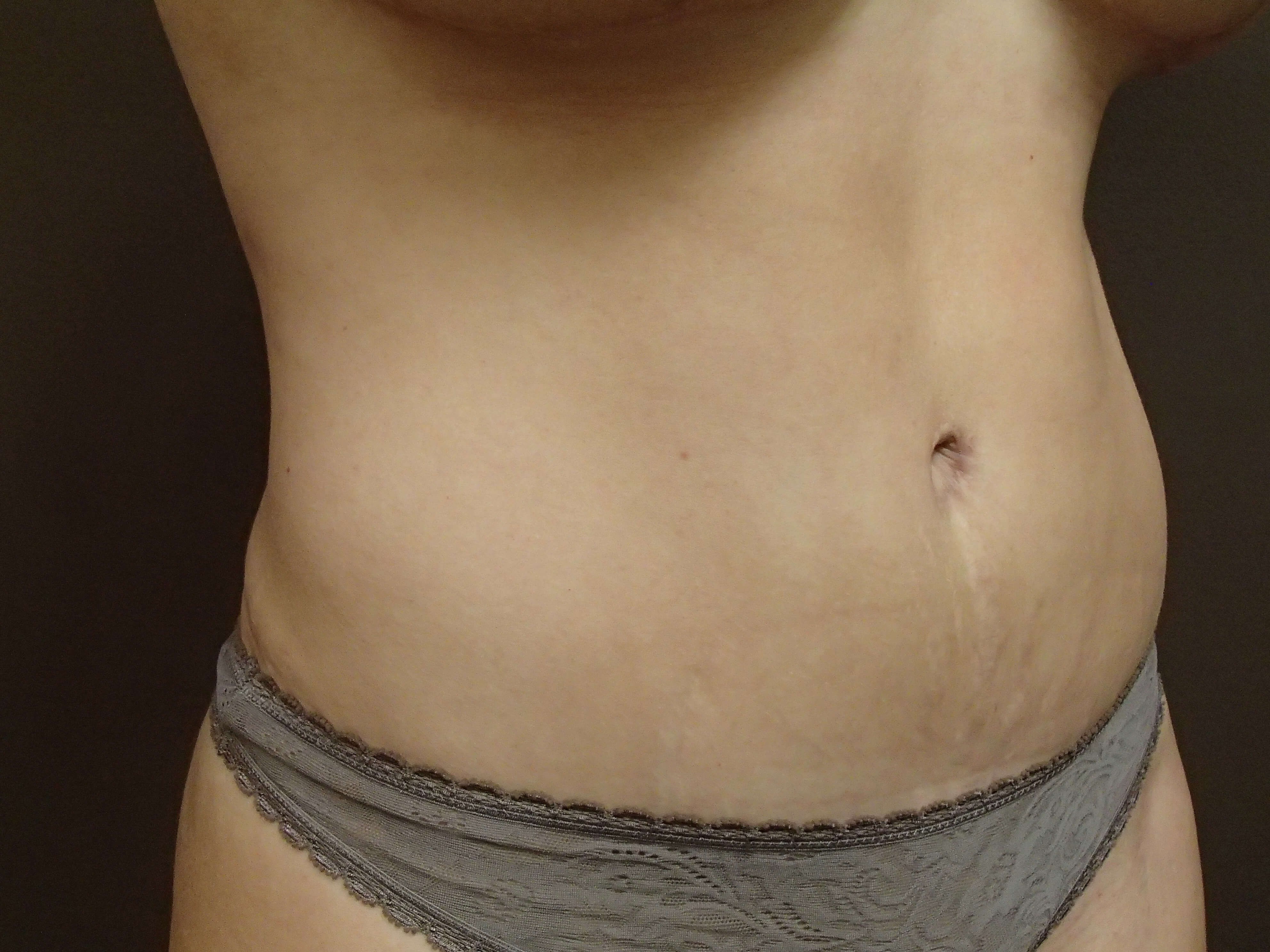 Timeless Tuck Oblique View After