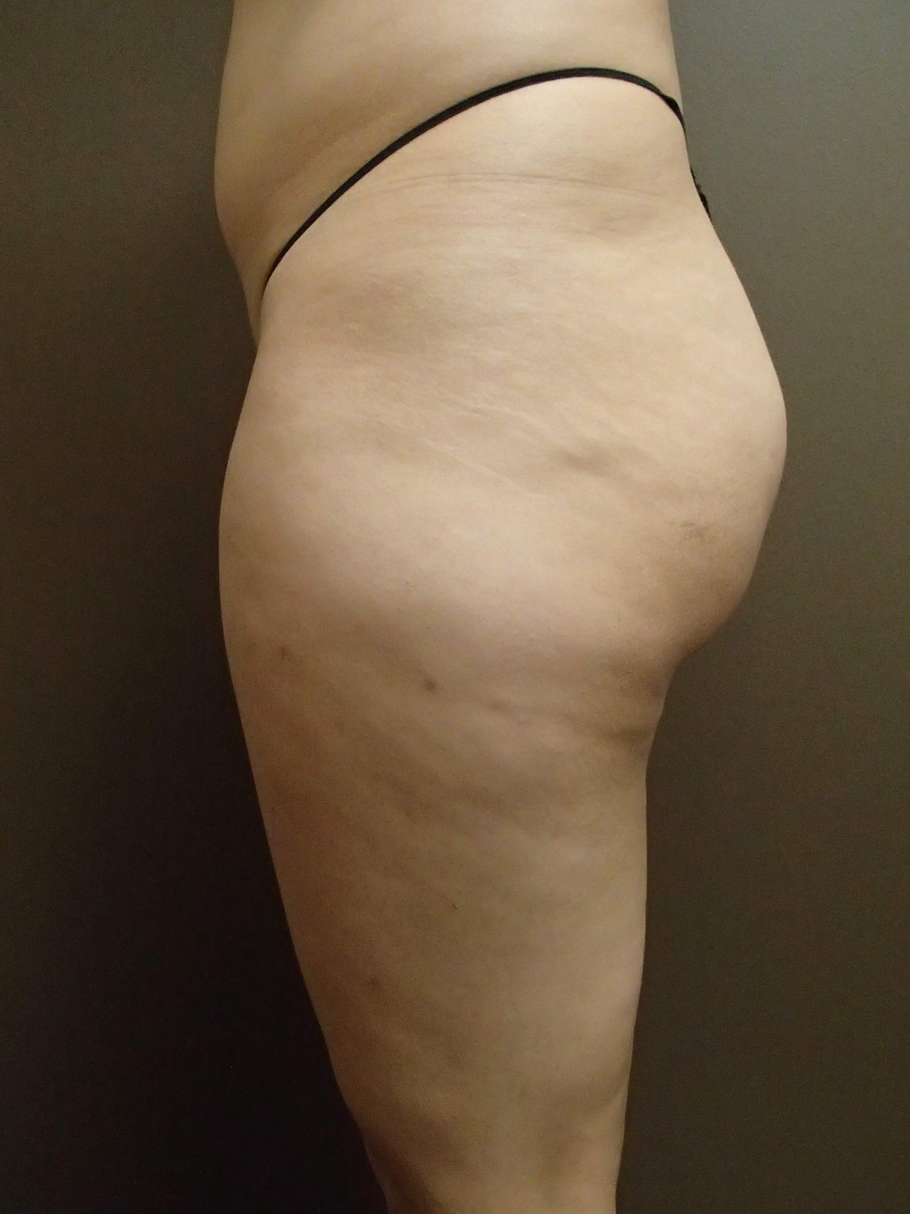 Buttock Augmentation Before