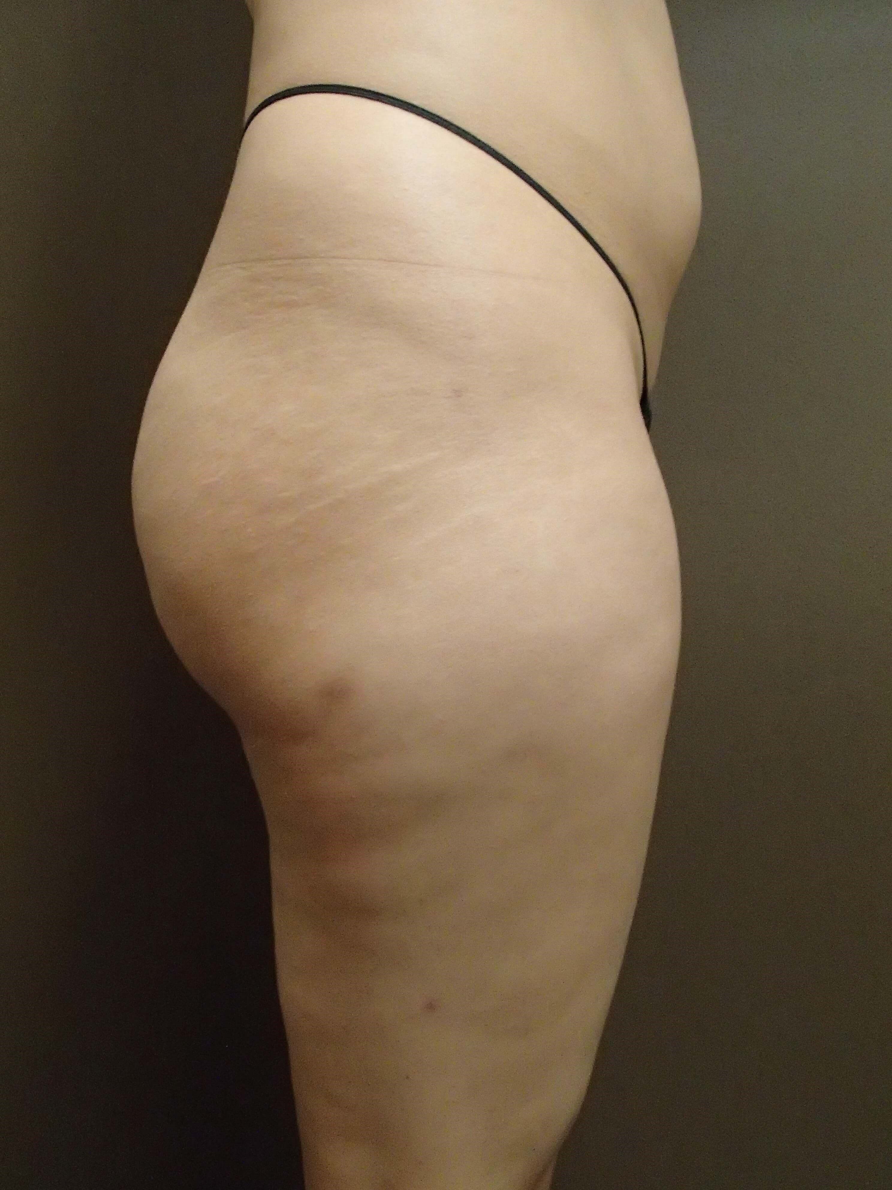 Buttock Augmentation Before
