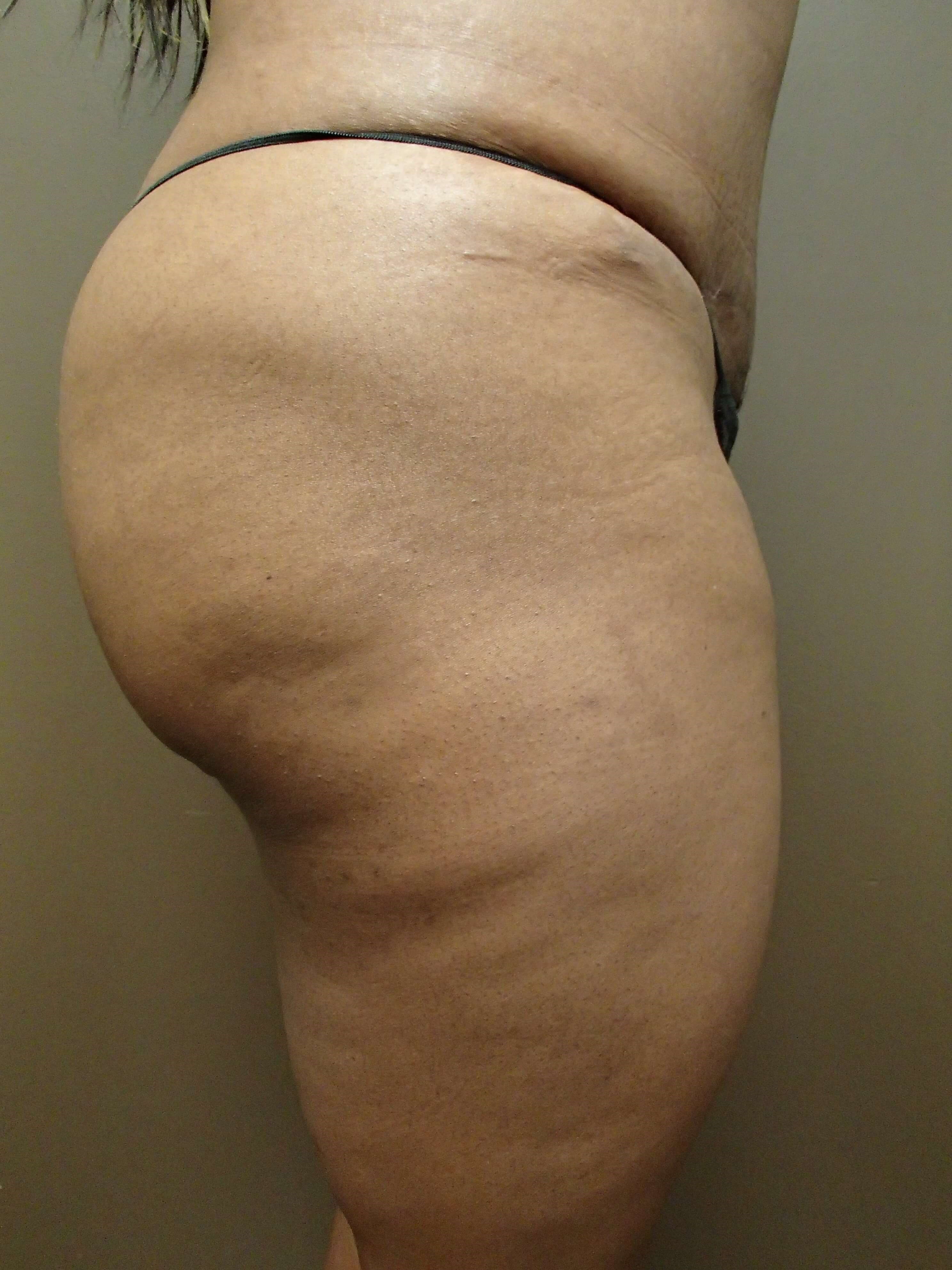 Auto Fat to Buttocks After