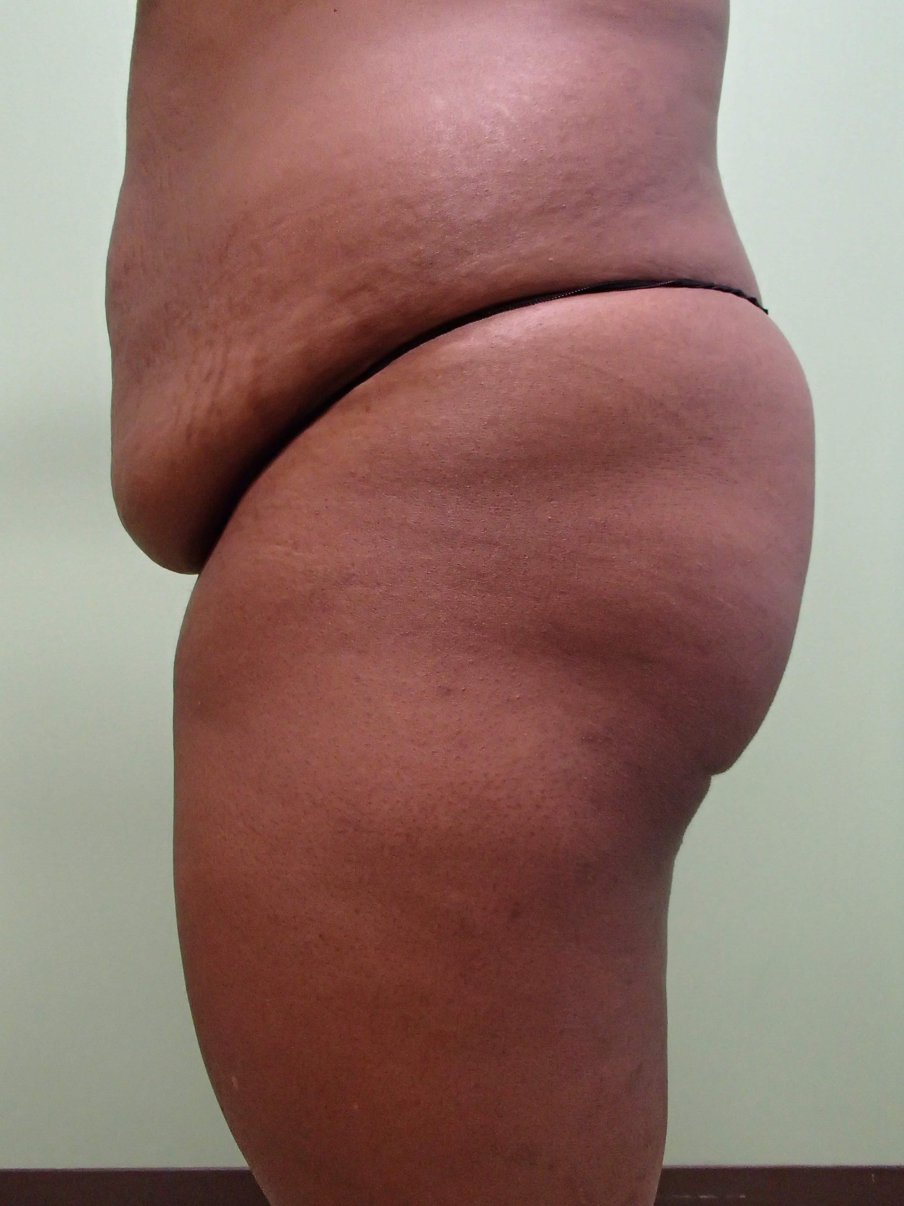 Auto Fat to Buttocks Before