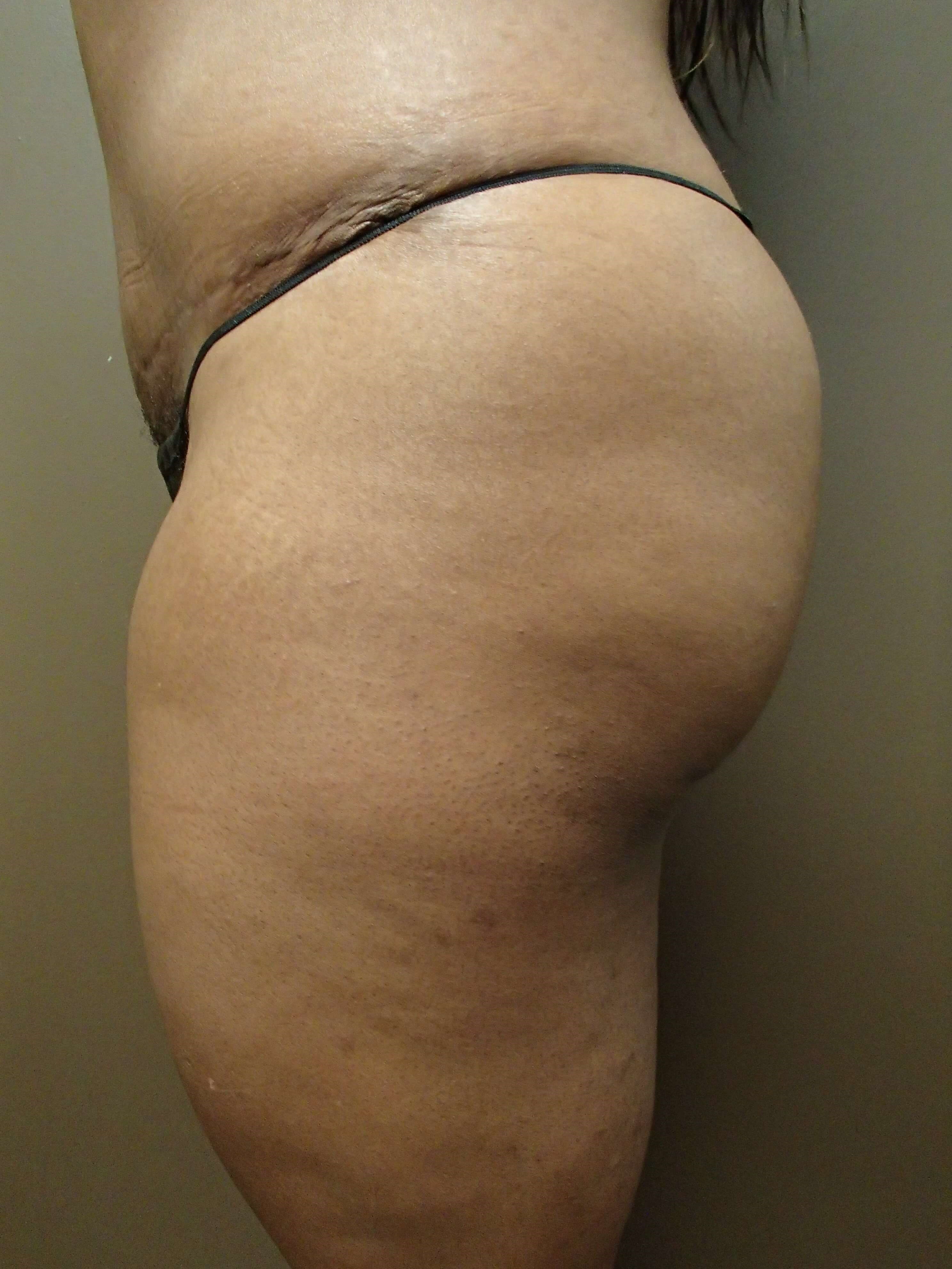 Auto Fat to Buttocks After