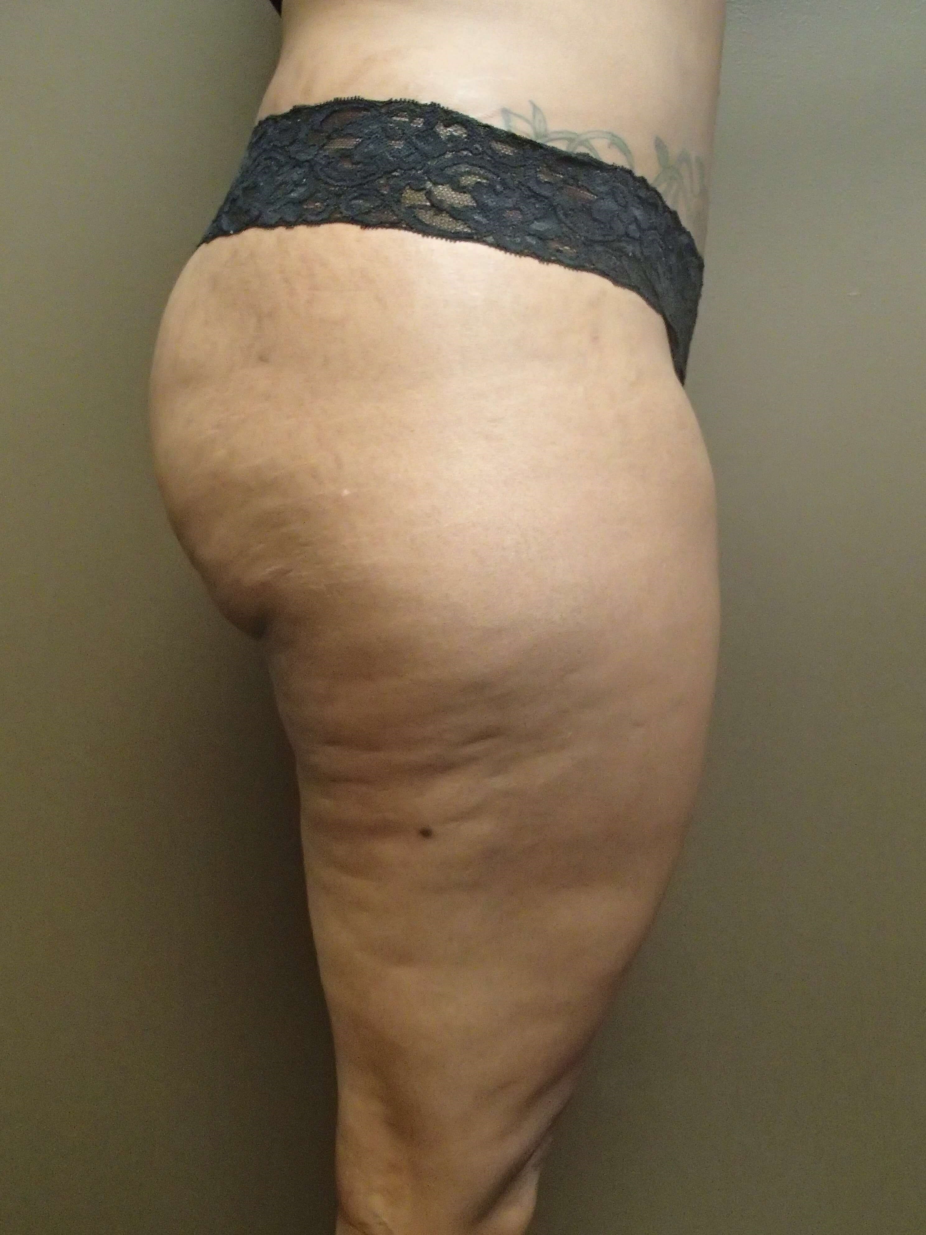 Auto Fat to Buttocks Before