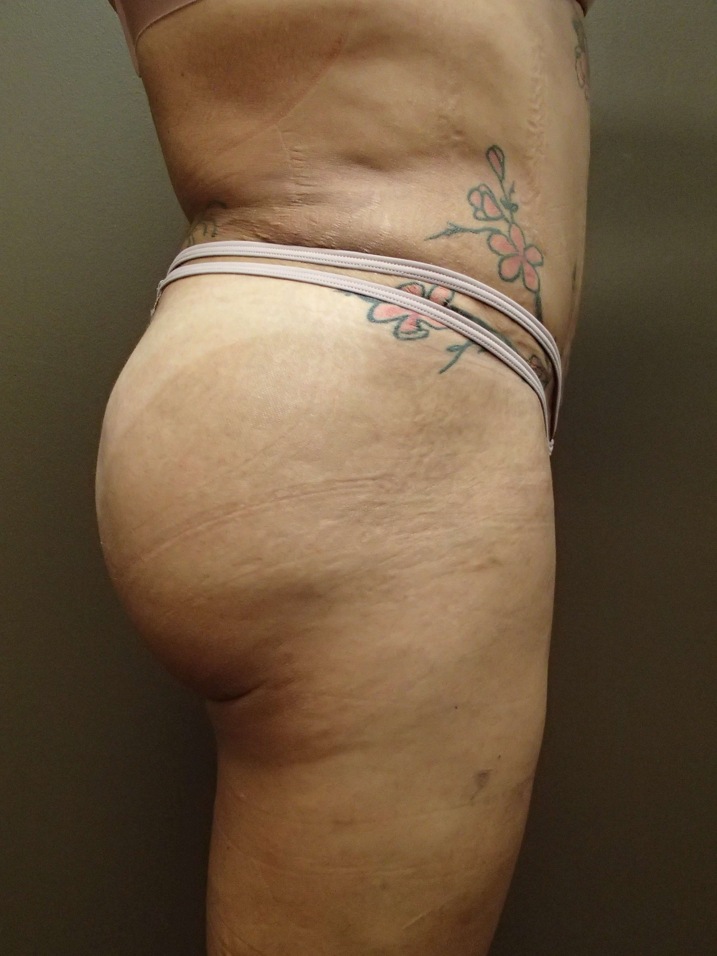 Brazilian Butt Lift (BBL) After