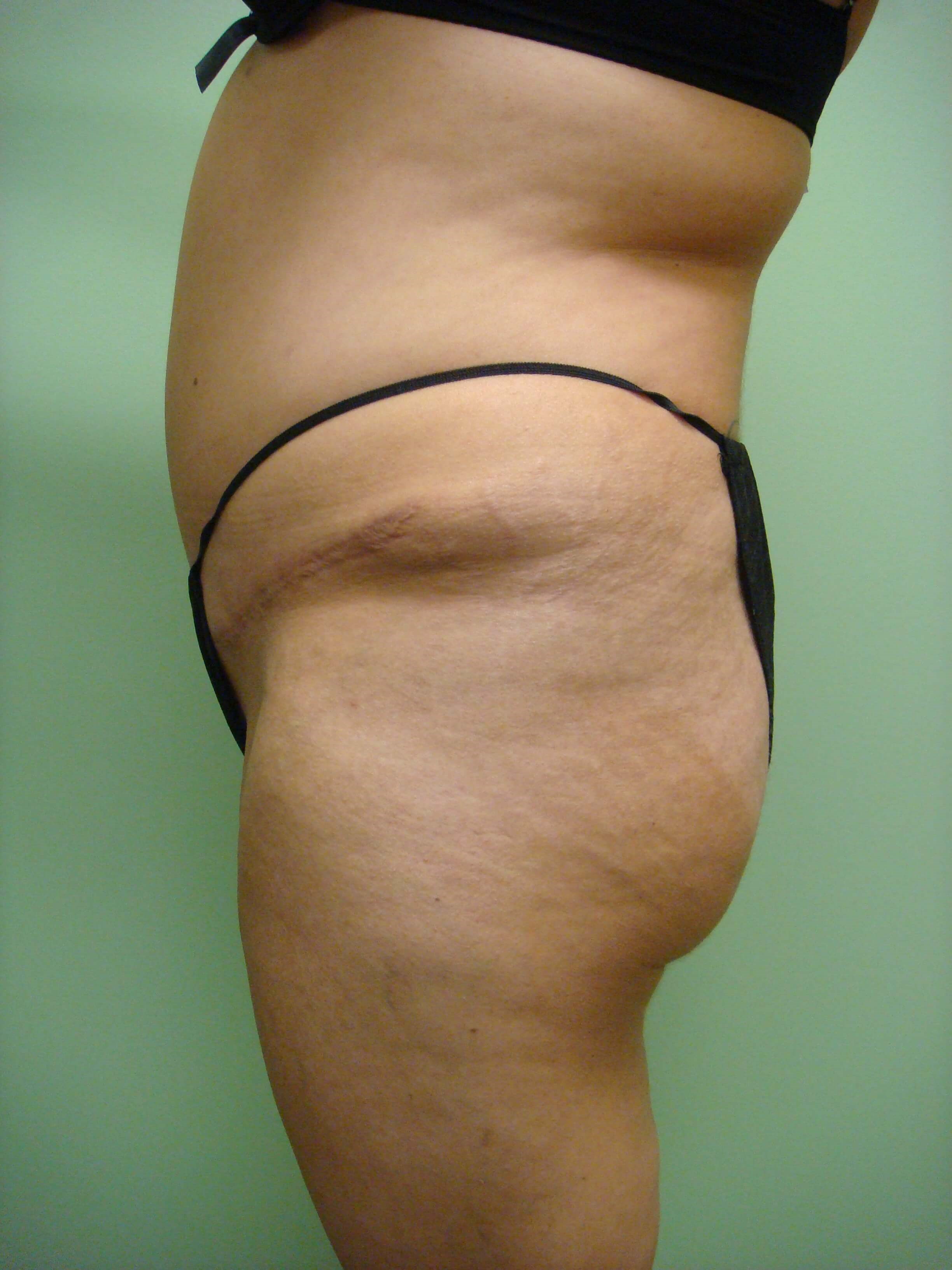 Brazilian Butt Lift (BBL) Before