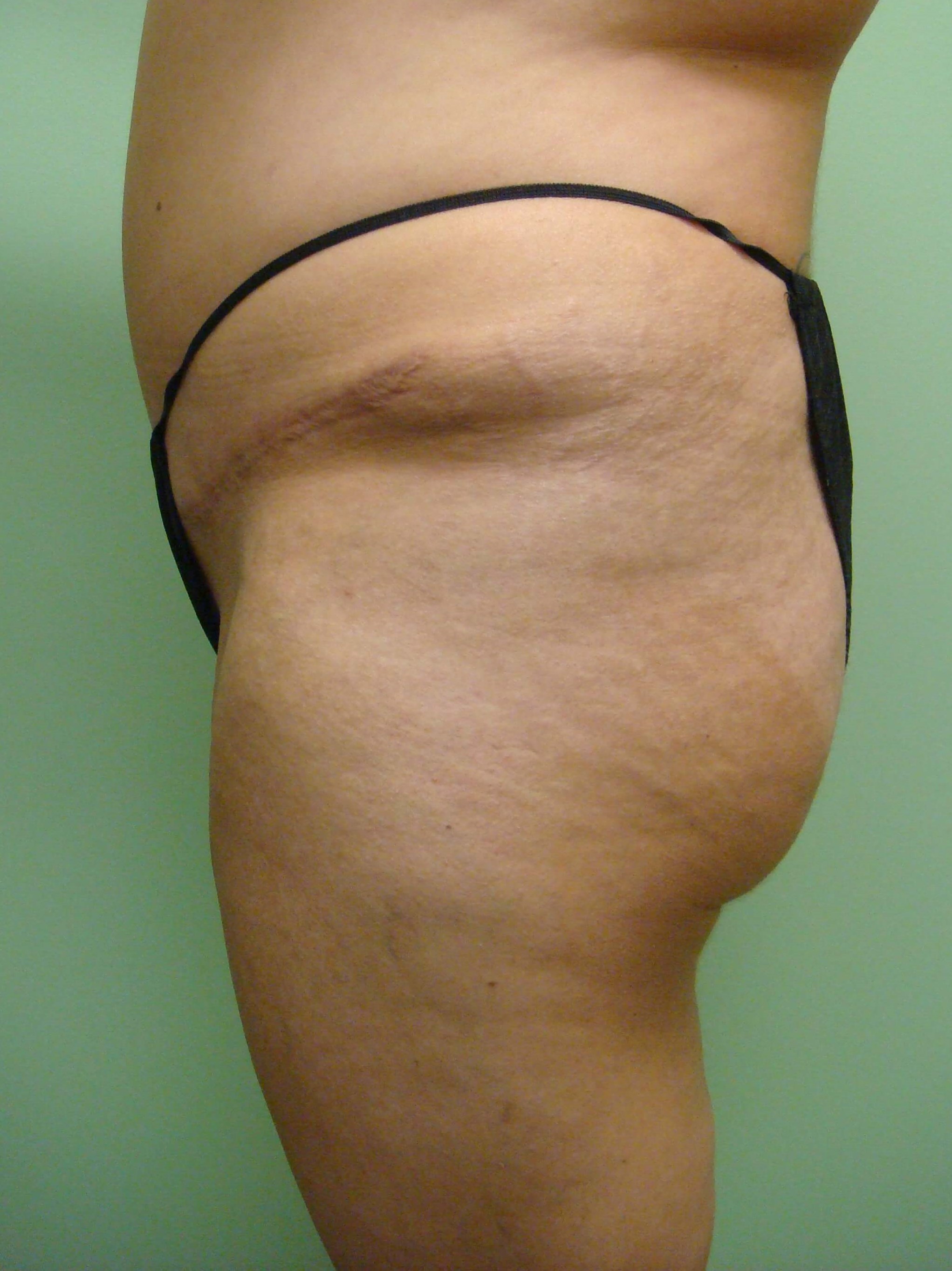Brazilian Butt Lift (BBL) Before