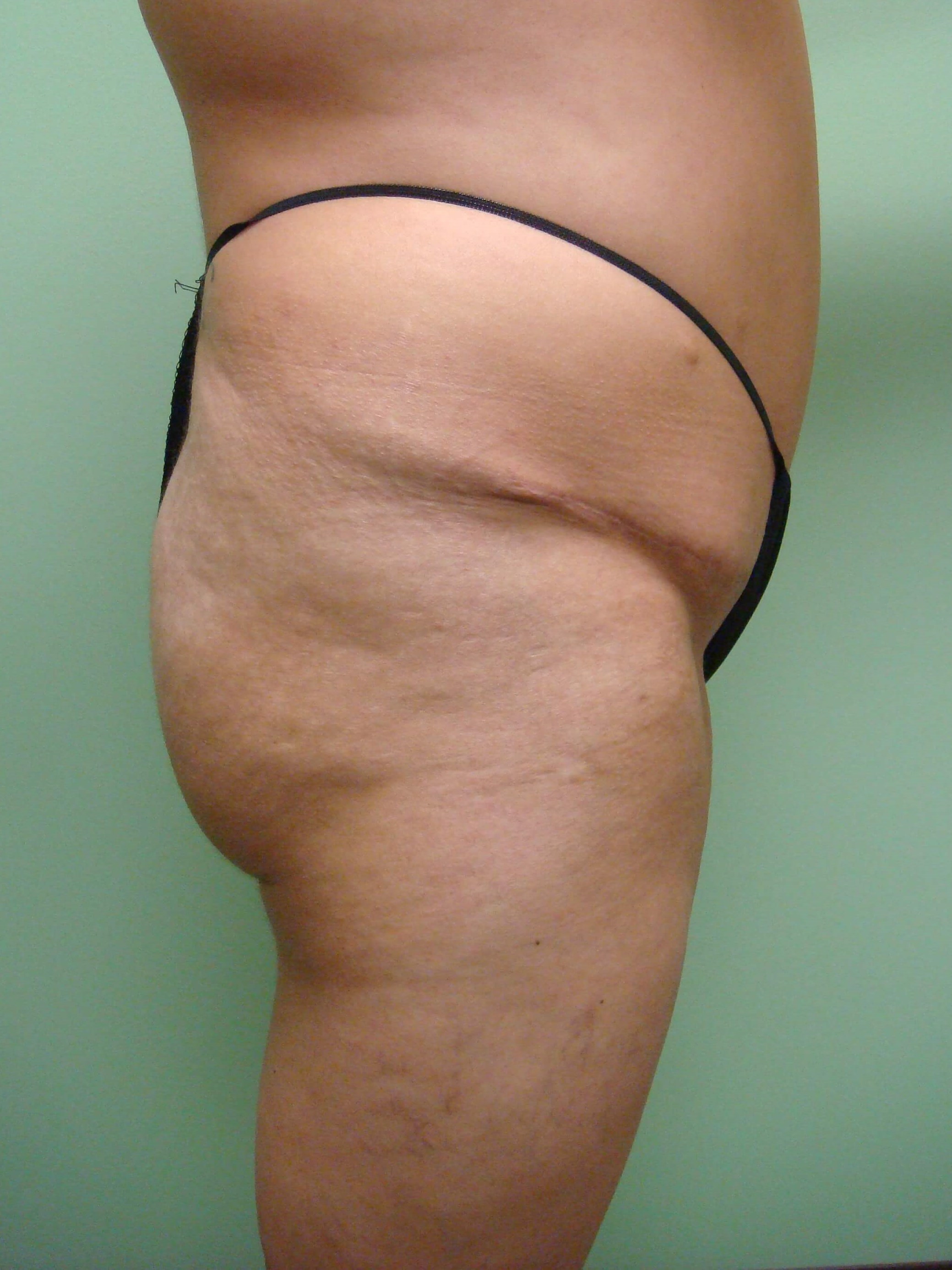 Brazilian Butt Lift (BBL) Before