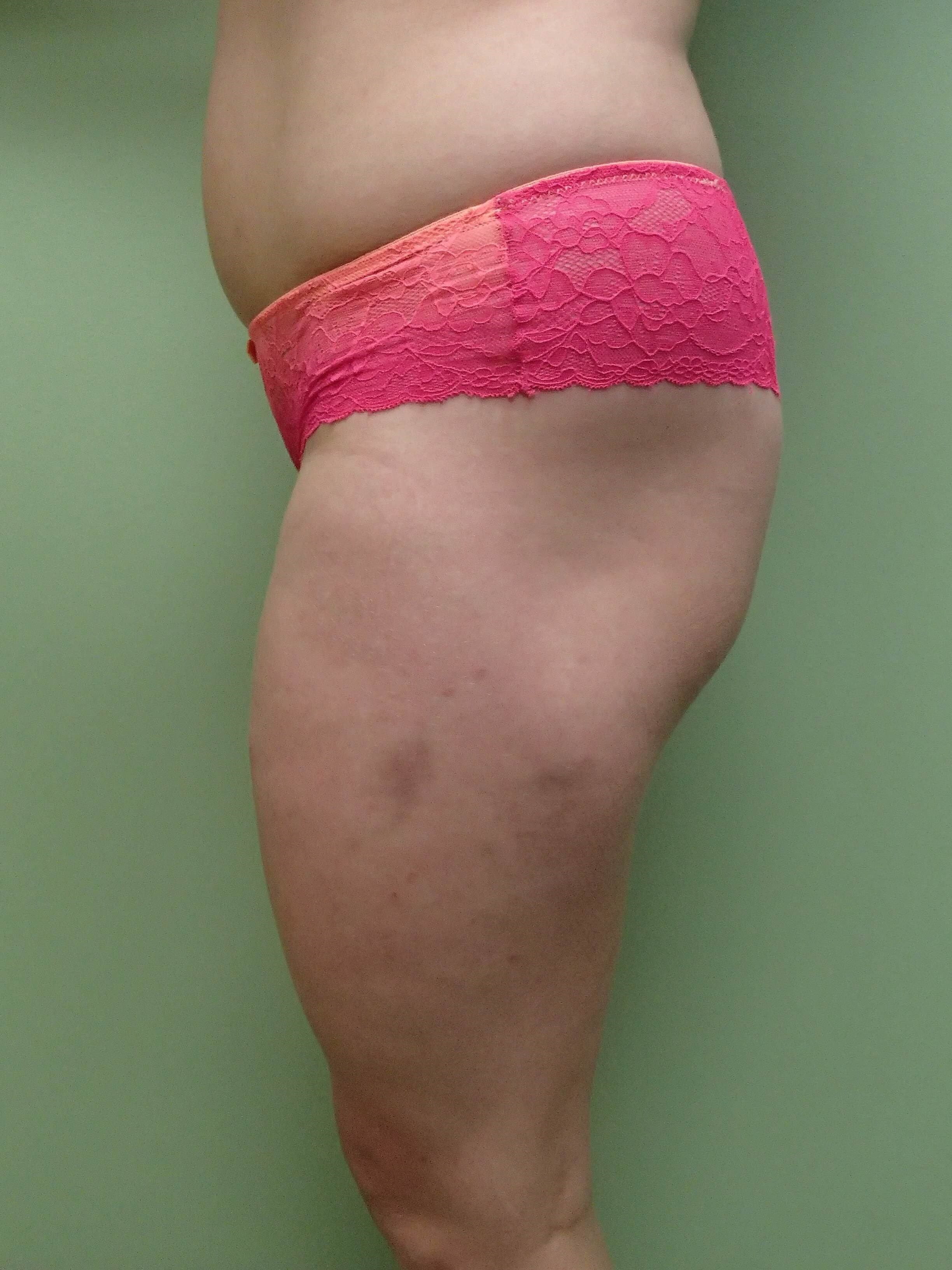 Auto Fat to Buttocks Before