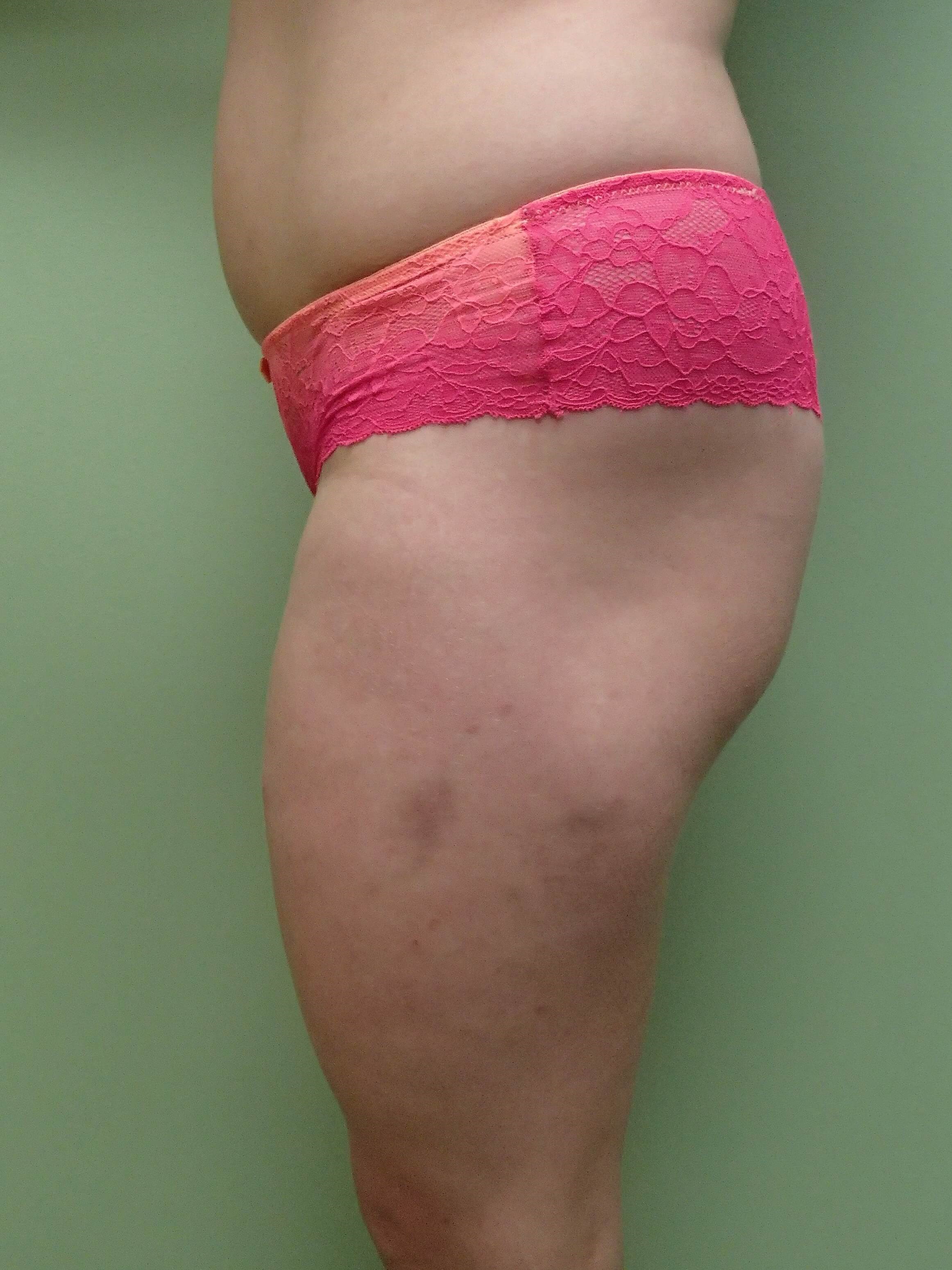 Auto Fat to Buttocks Before