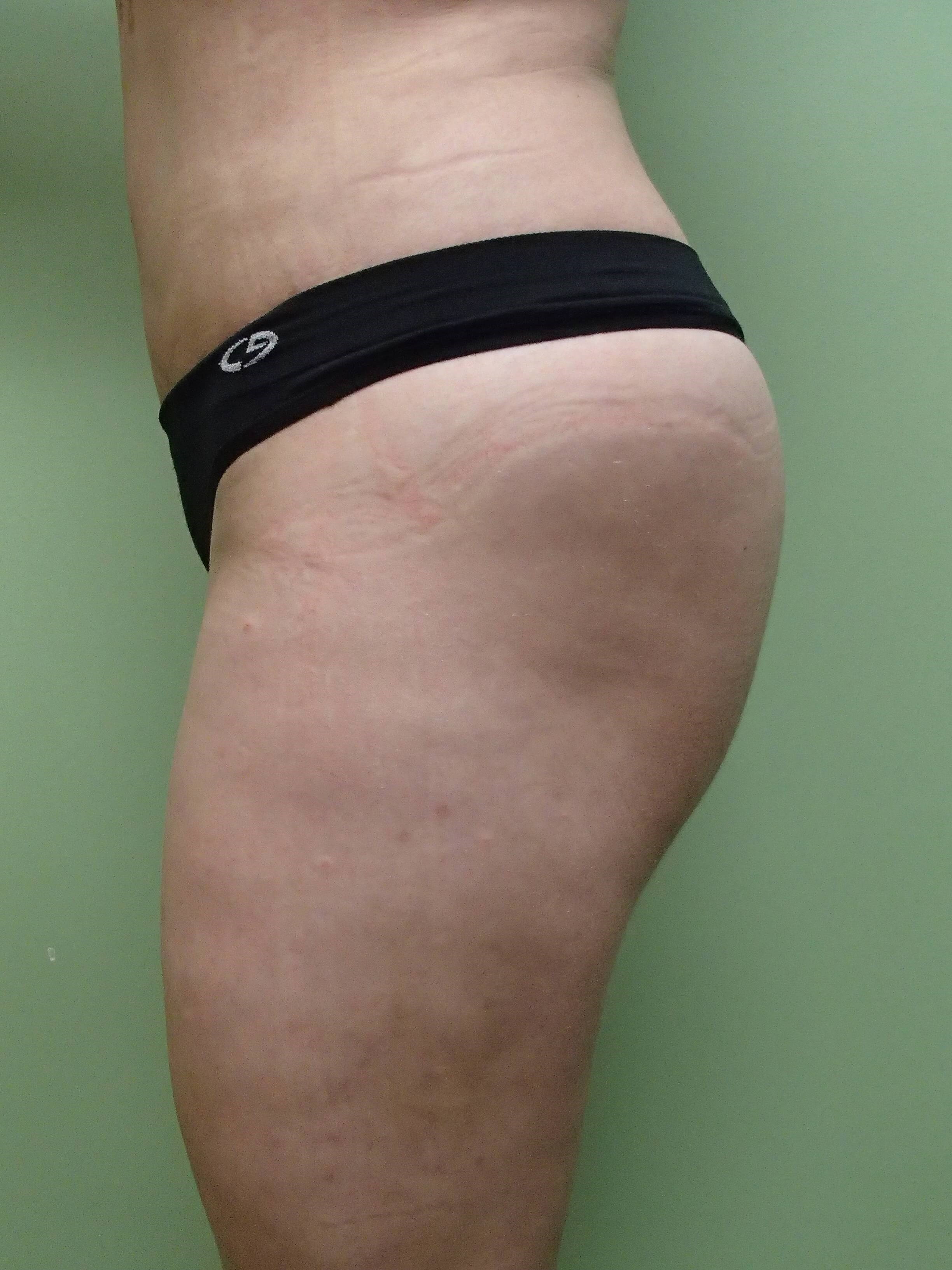 Auto Fat to Buttocks After