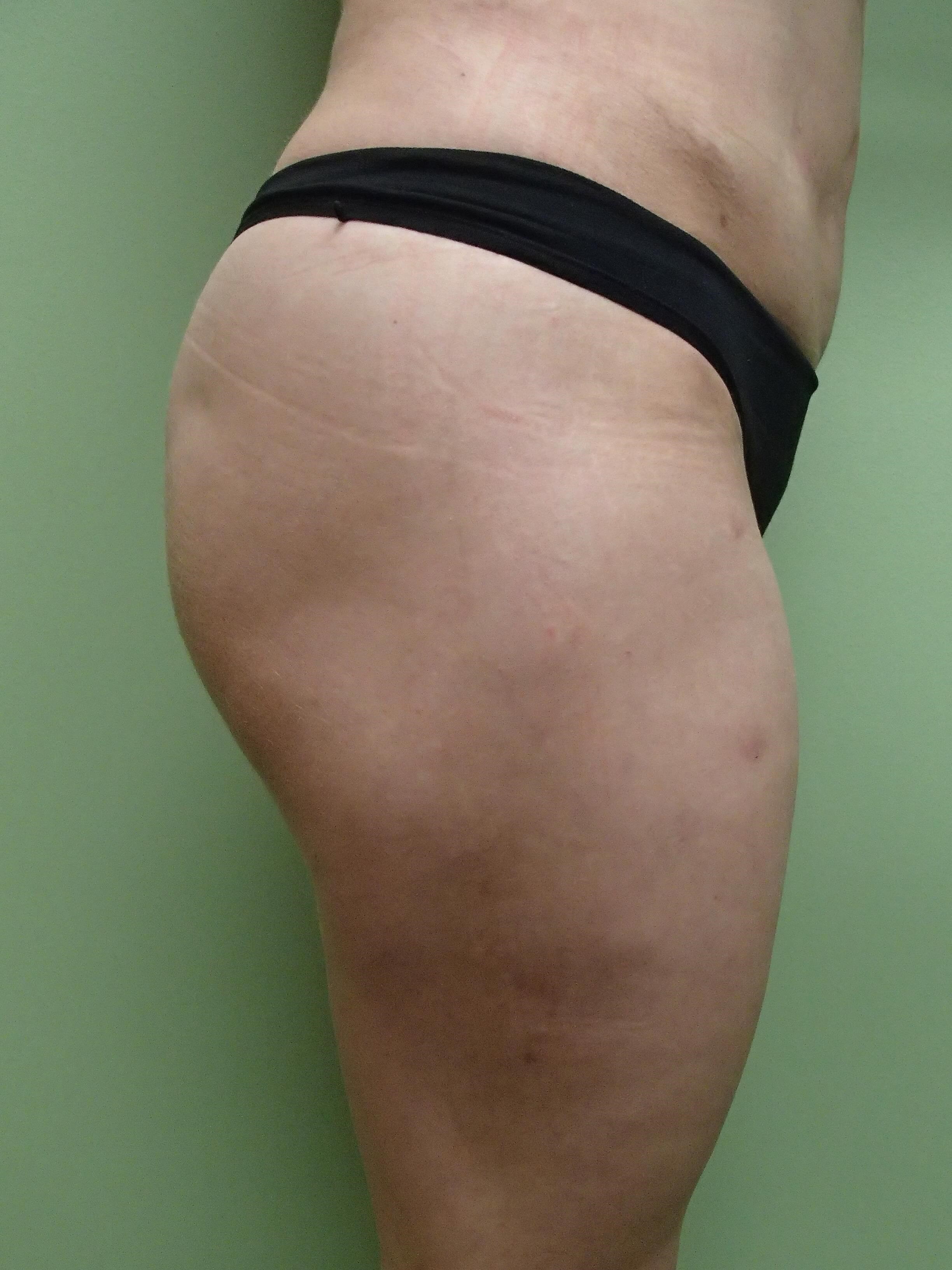 Auto Fat to Buttocks After