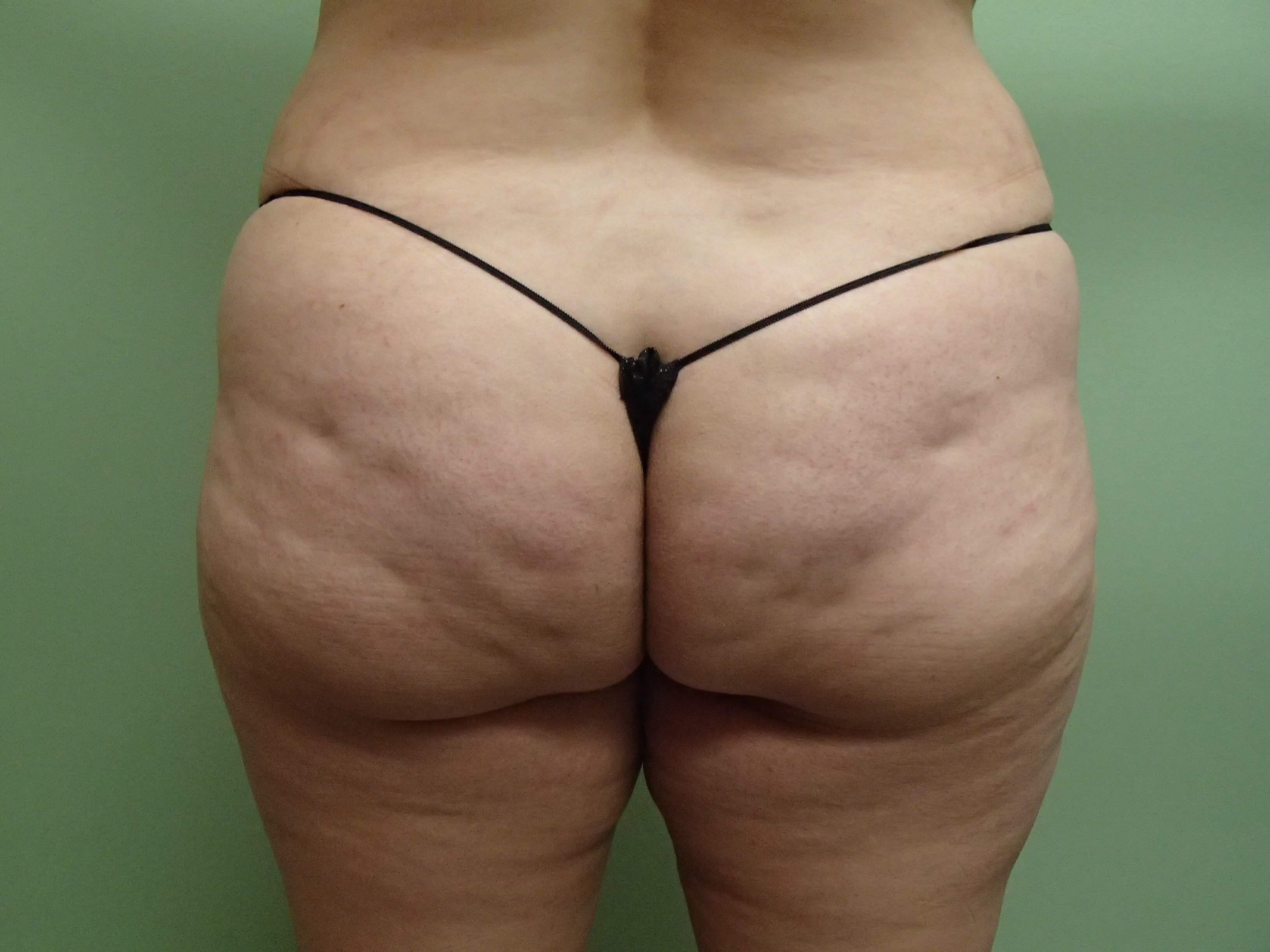 Auto Fat to Buttocks Before