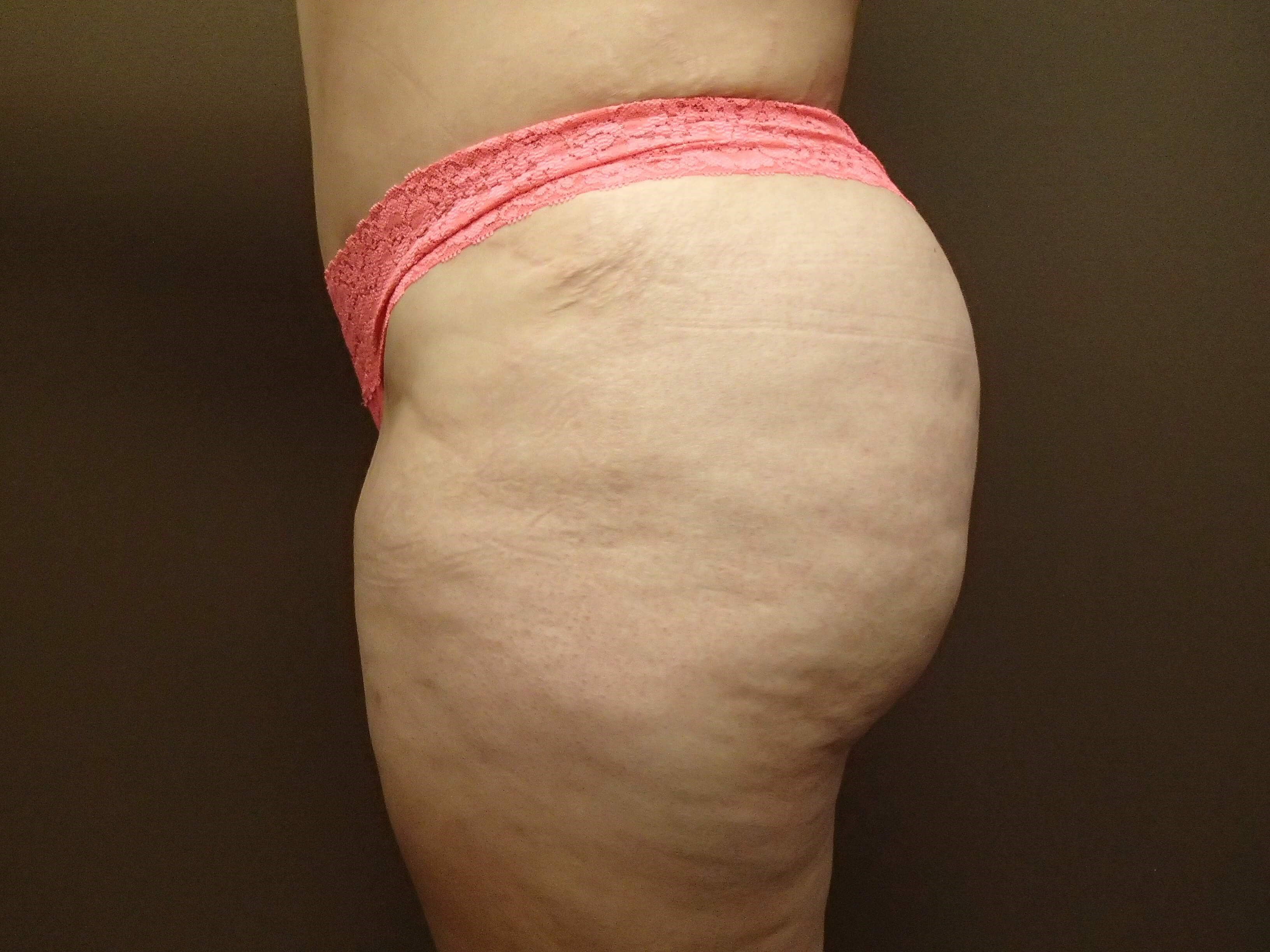 Auto Fat to Buttocks After
