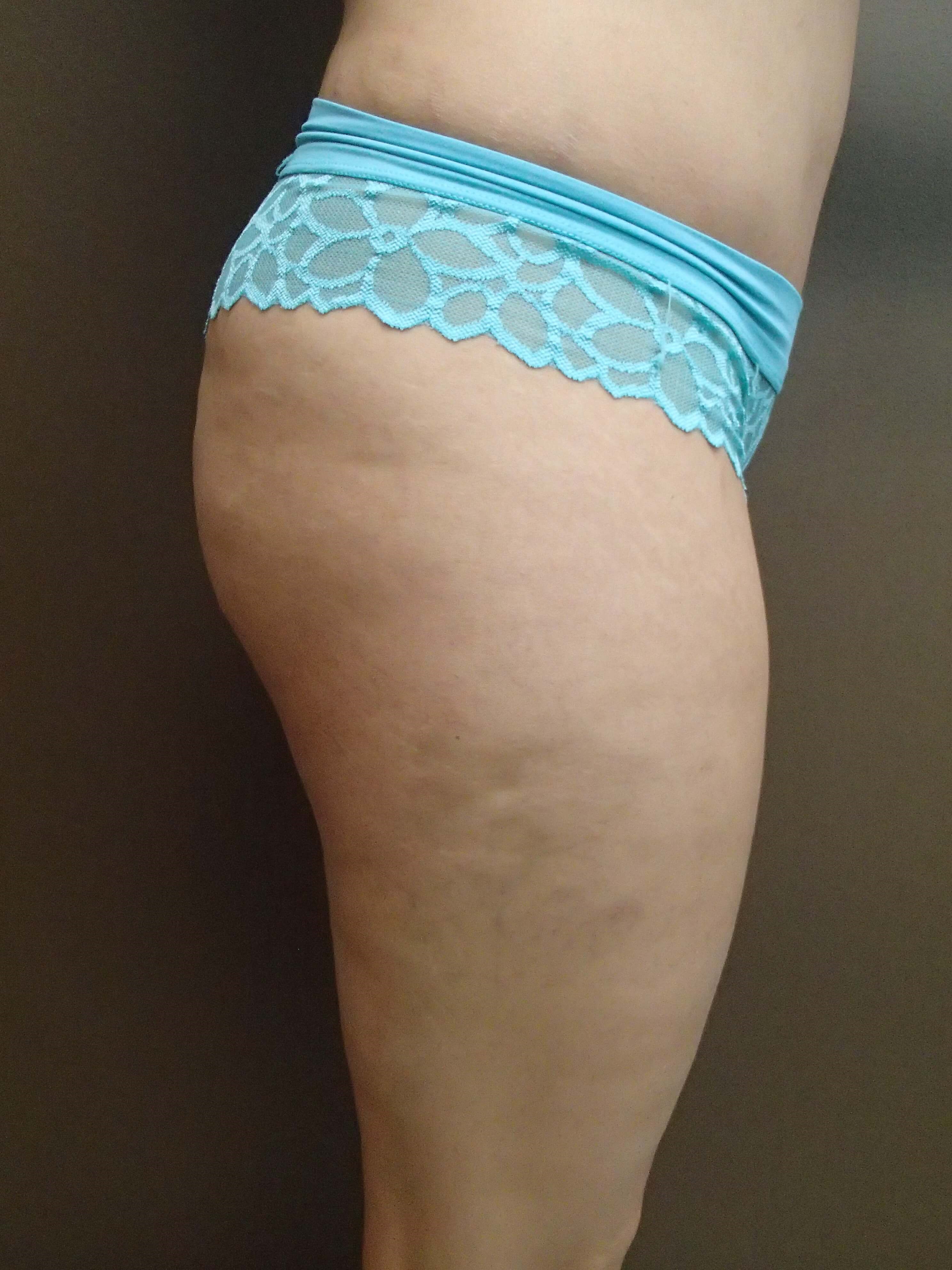 Brazilian Butt Lift (BBL) Before