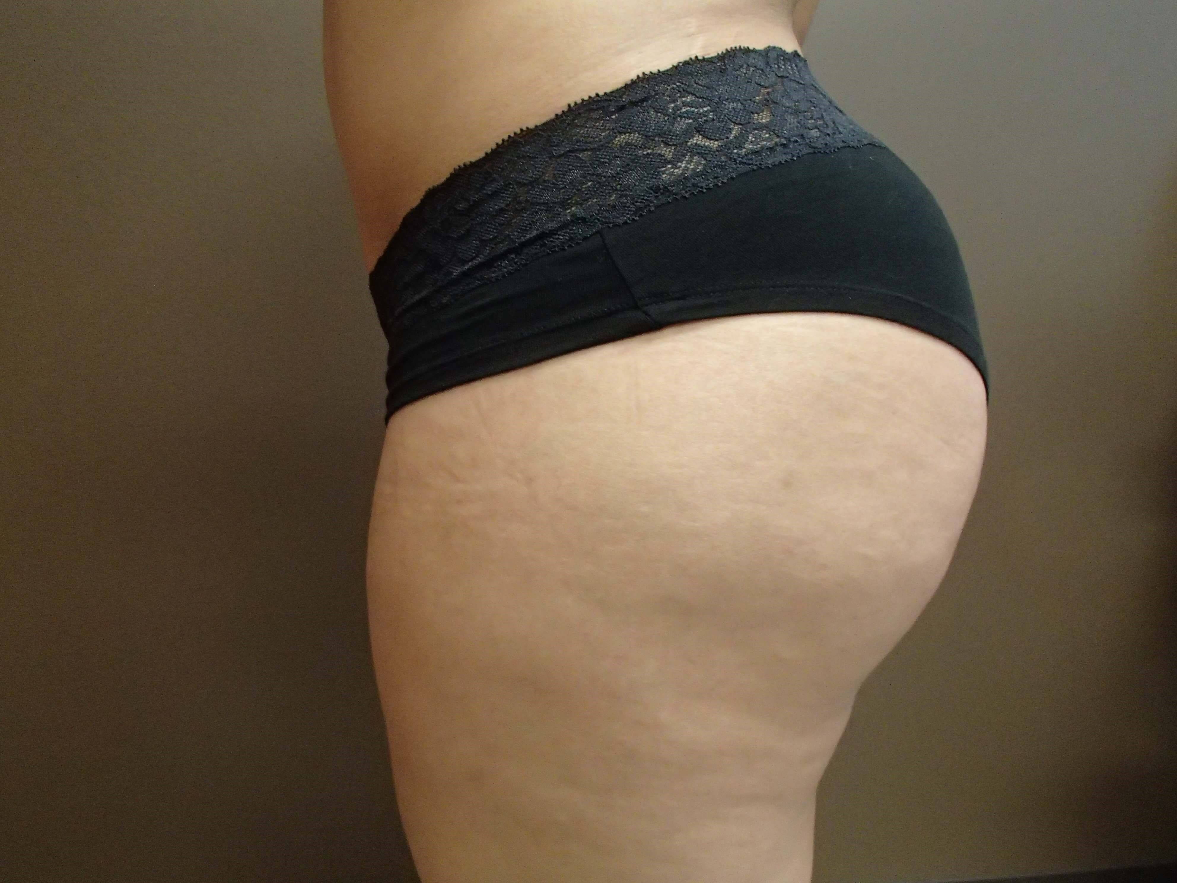 Brazilian Butt Lift (BBL) After