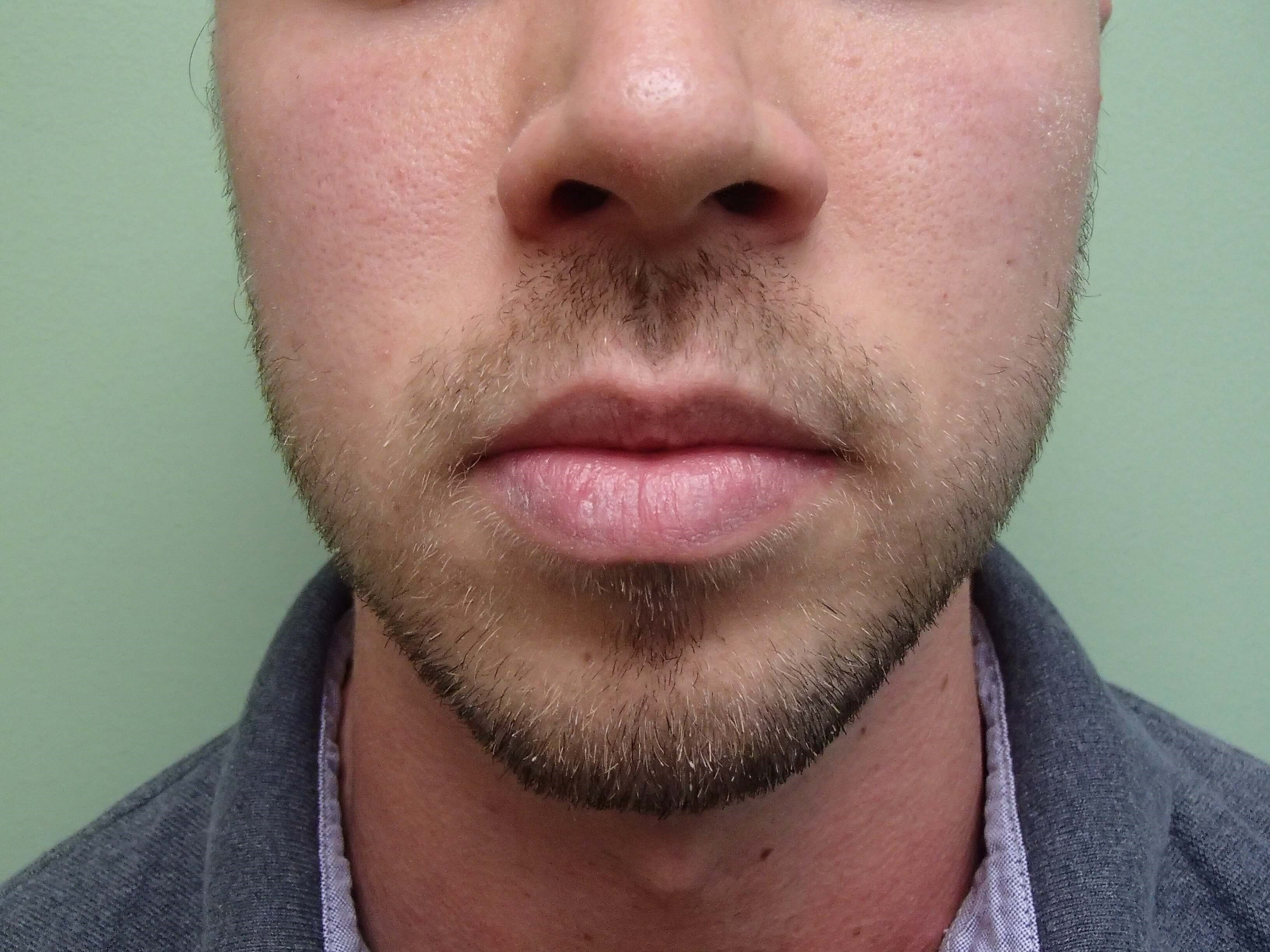 Facial Contouring Before