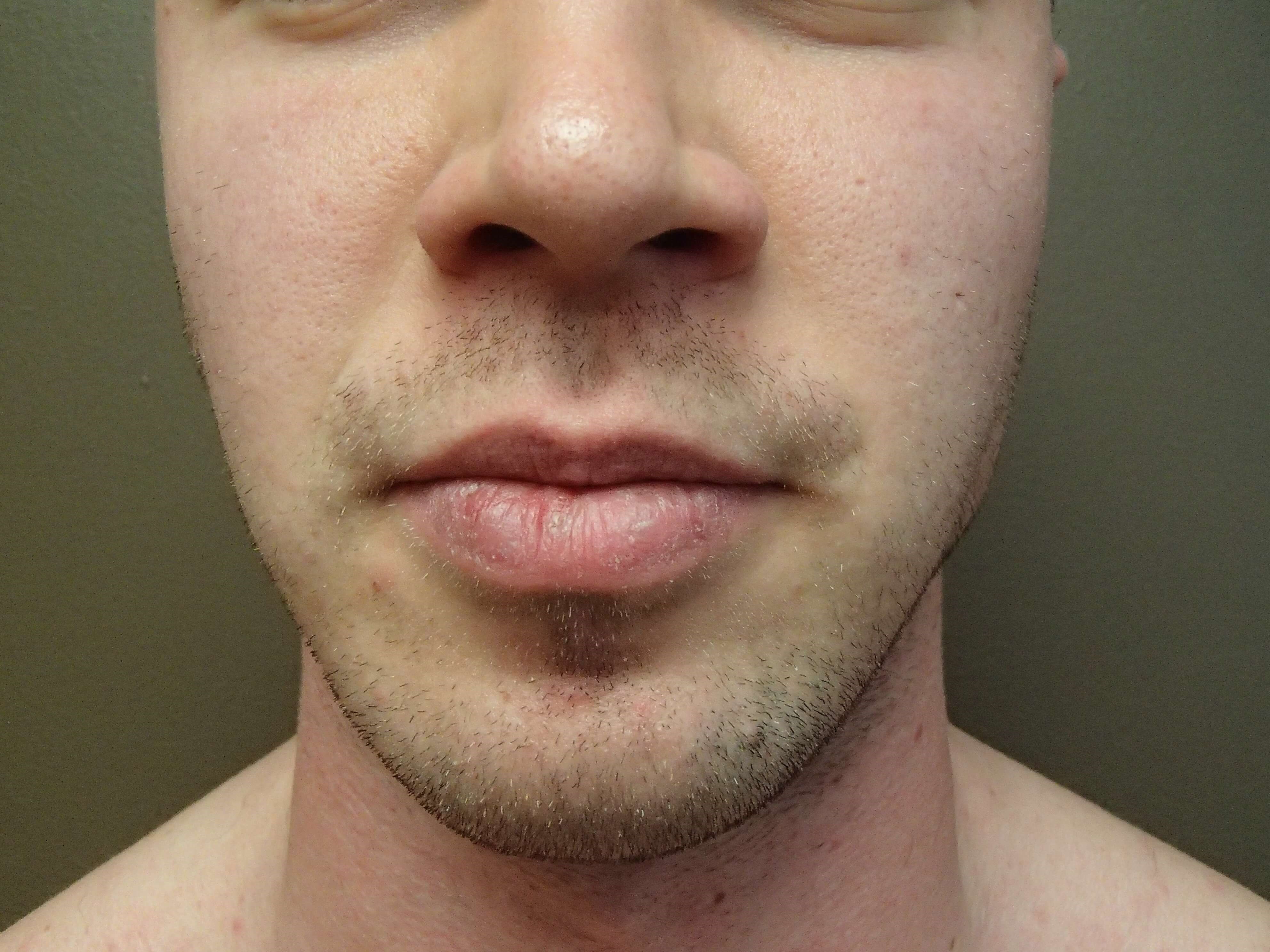 Facial Contouring After