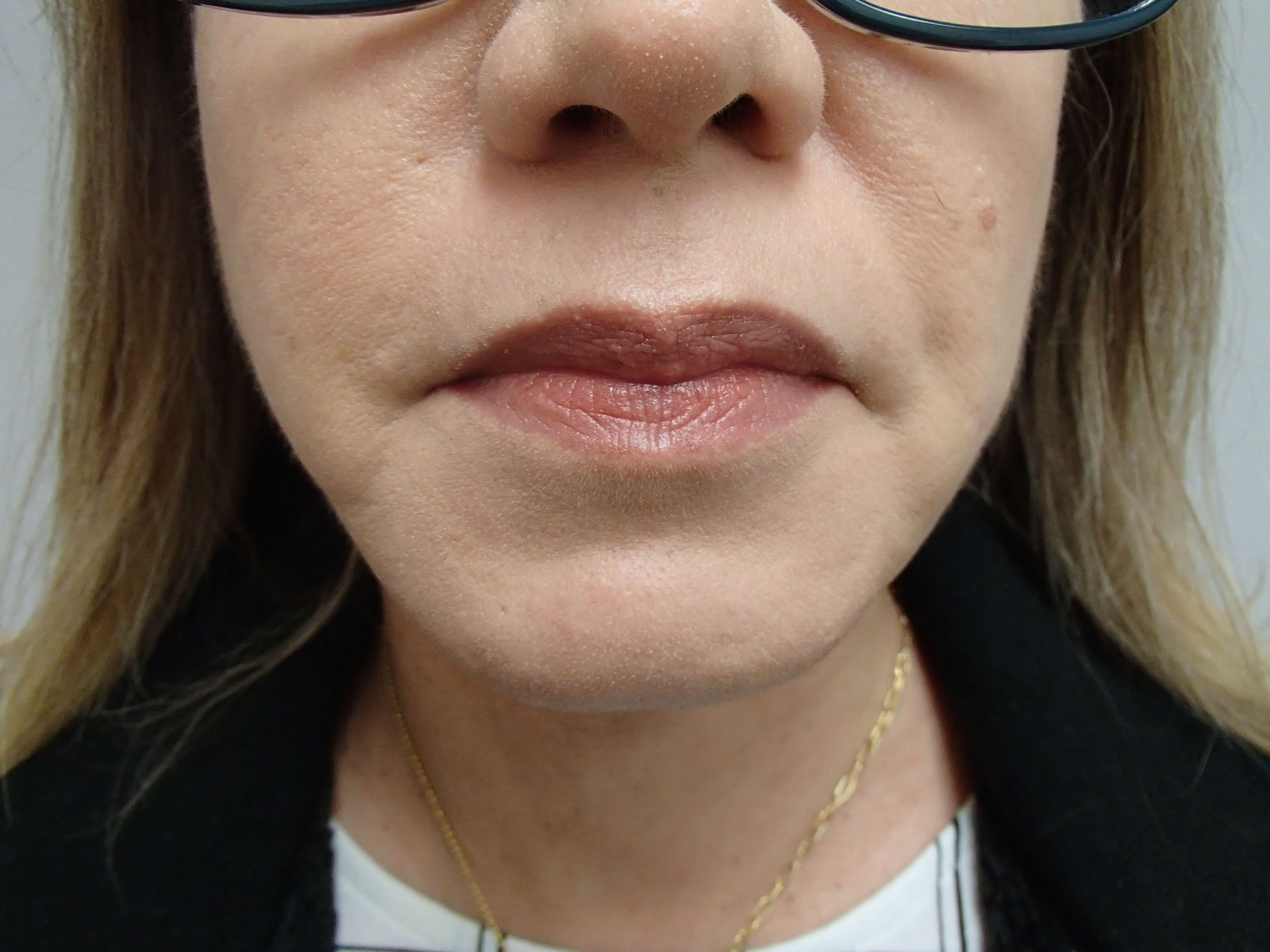 Platysmaplasty w/ Liposuction After