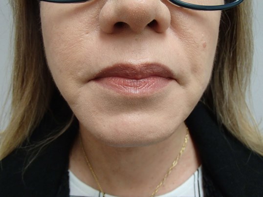 Platysmaplasty w/ Liposuction After