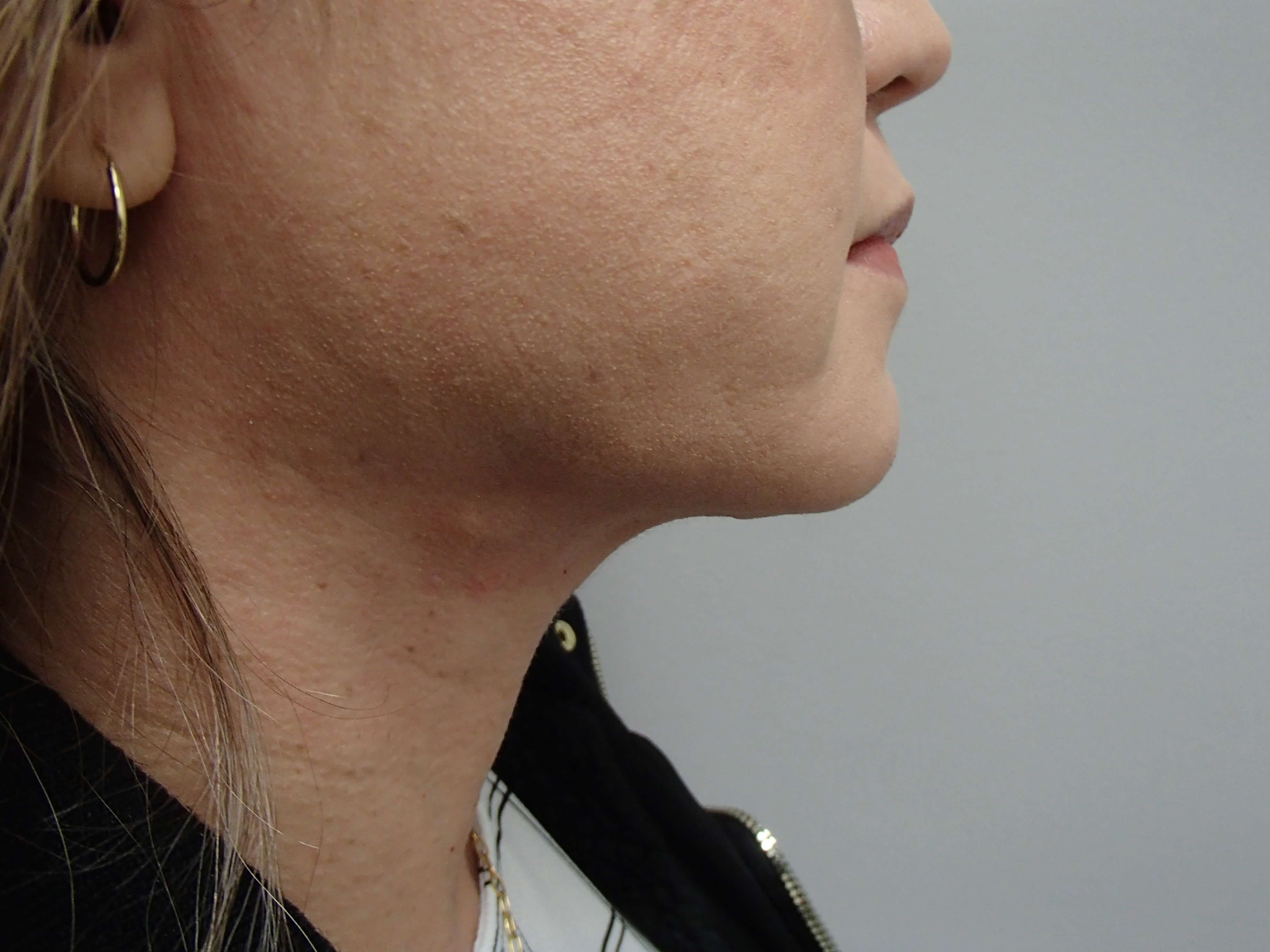 Platysmaplasty w/ Liposuction After