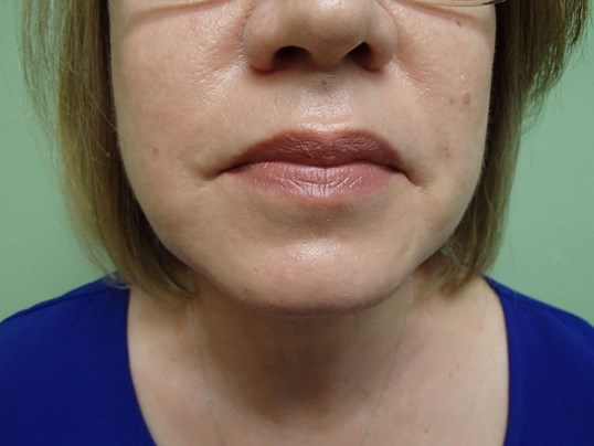 Platysmaplasty w/ Liposuction Before