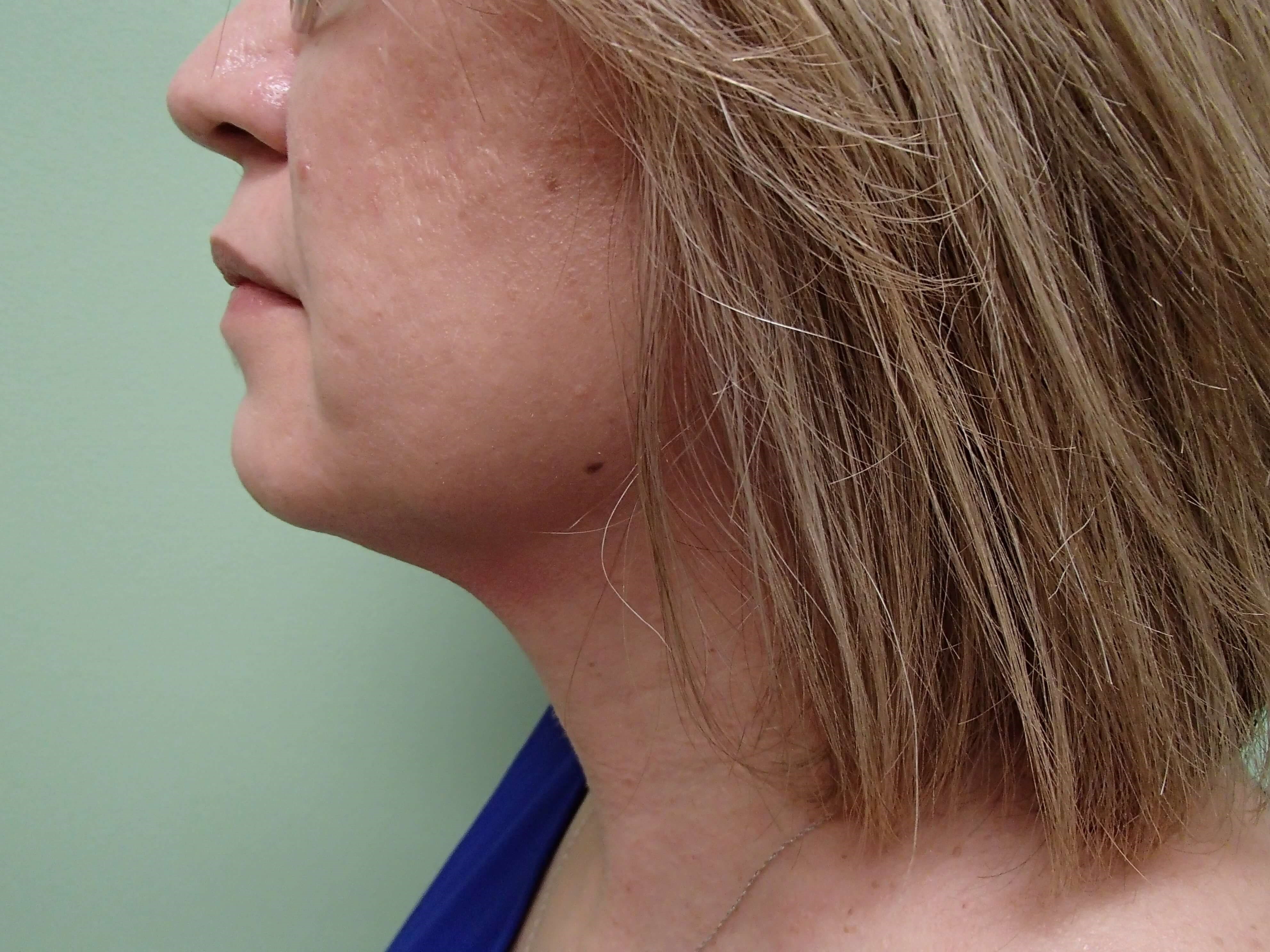Platysmaplasty w/ Liposuction Before
