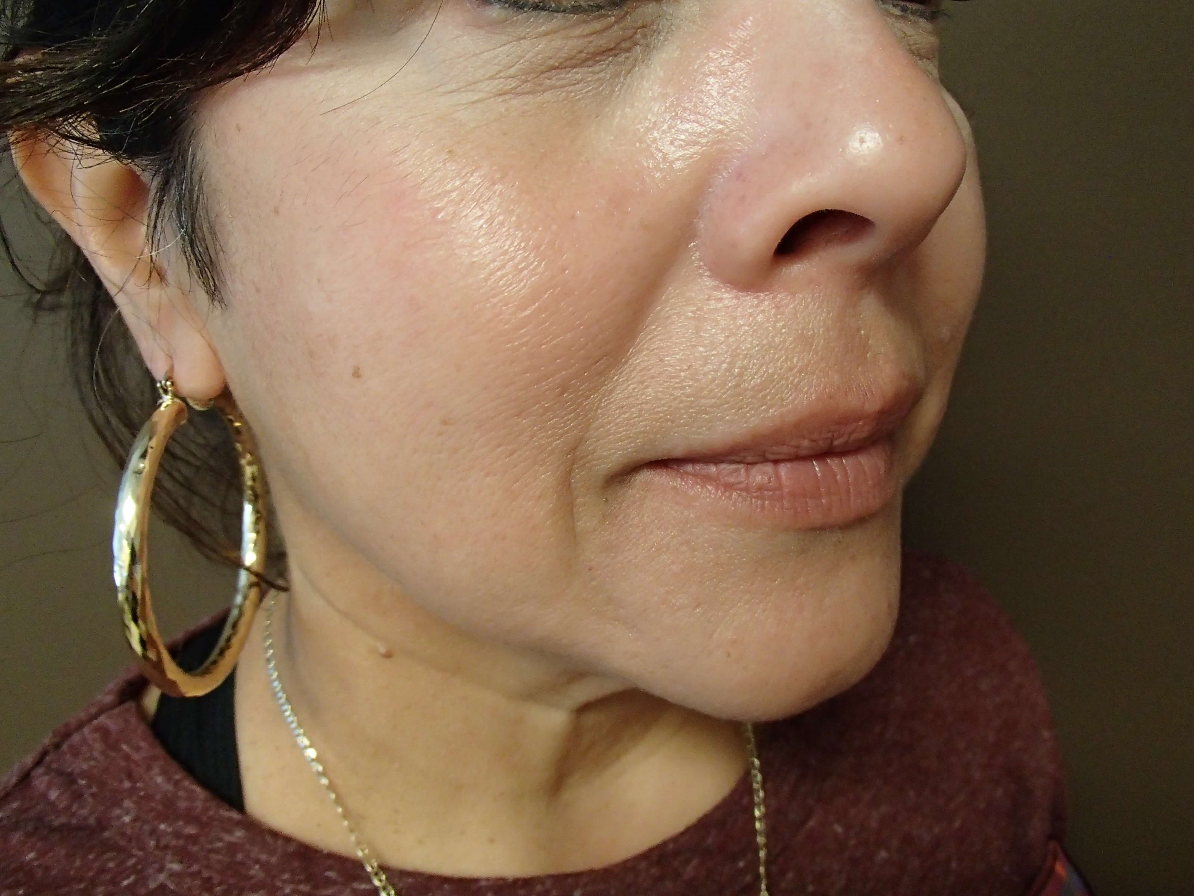 Facelift and Necklift Before