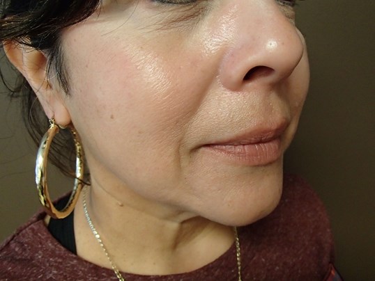 Facelift and Necklift Before