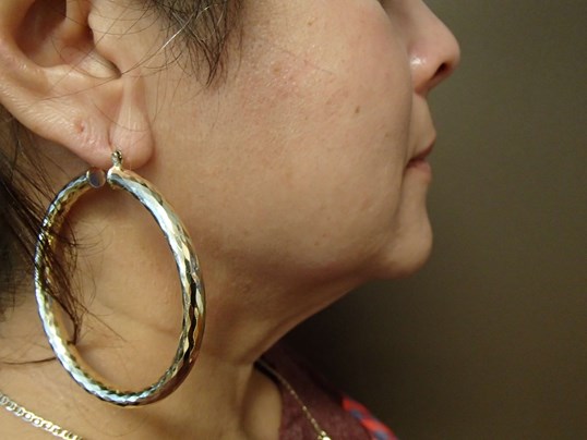 Facelift and Necklift Before