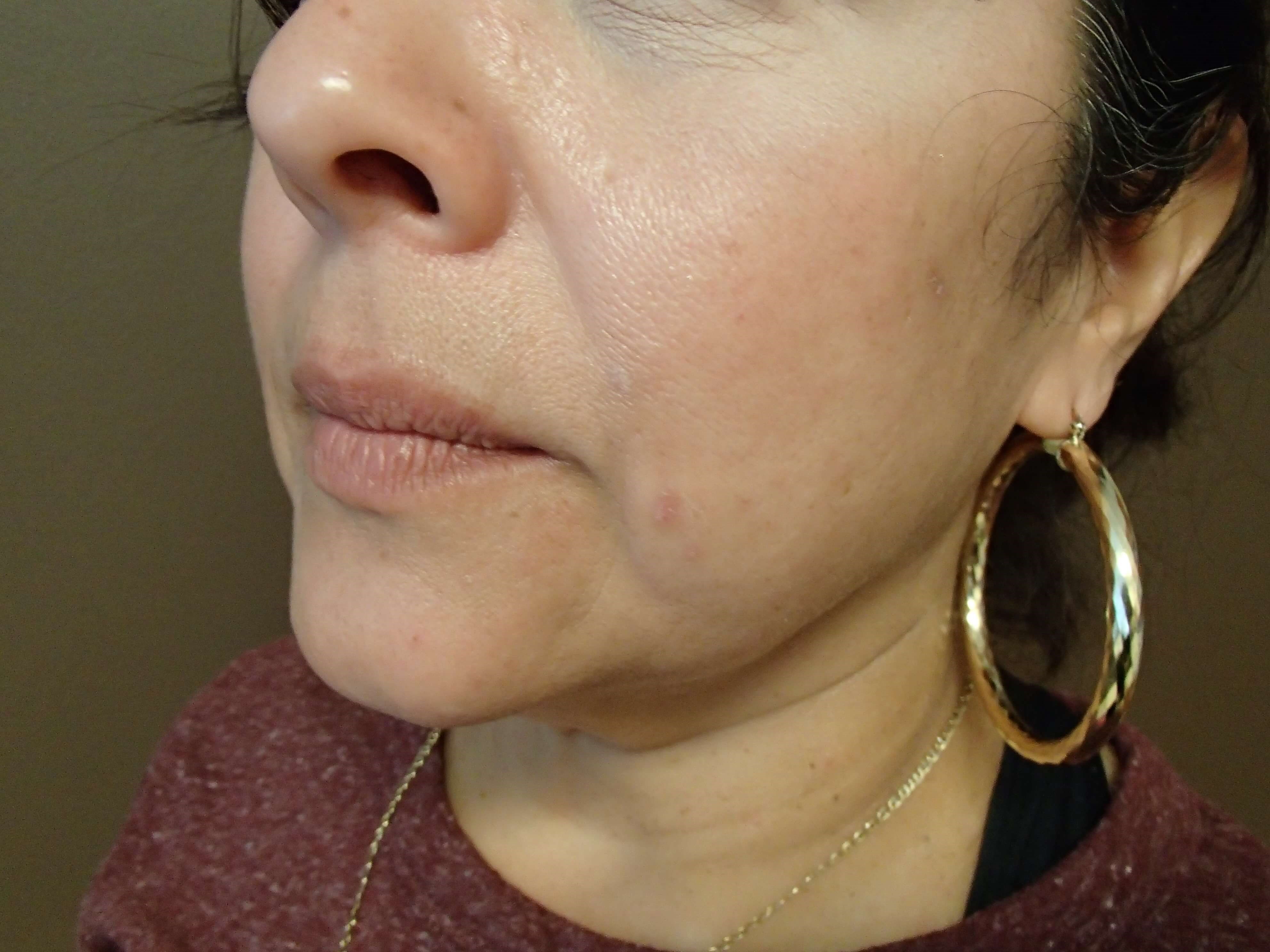 Facelift and Necklift Before