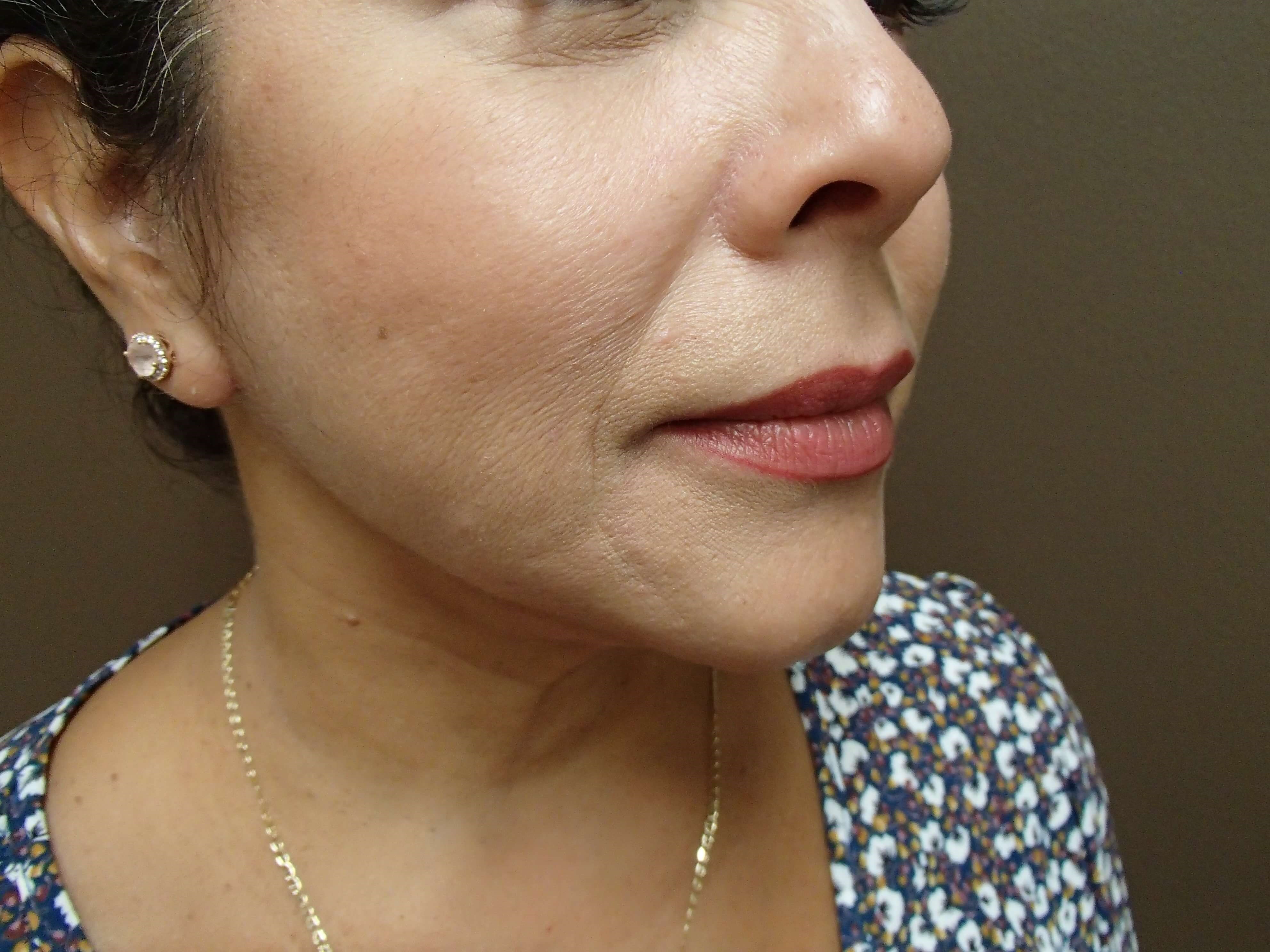 Facelift and Necklift After