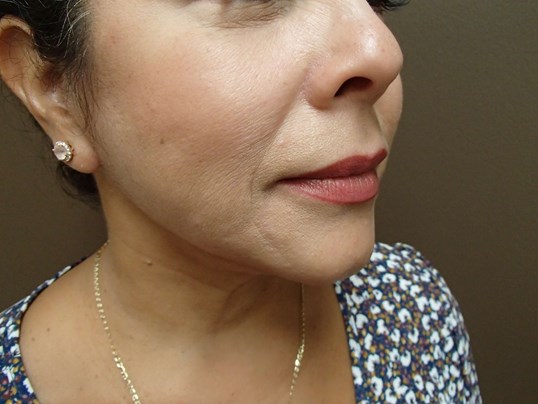 Facelift and Necklift After