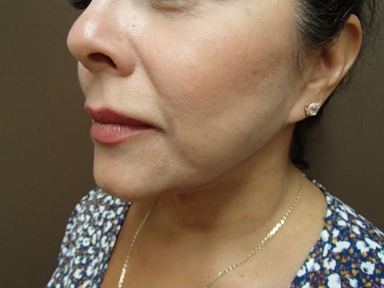Facelift and Necklift After