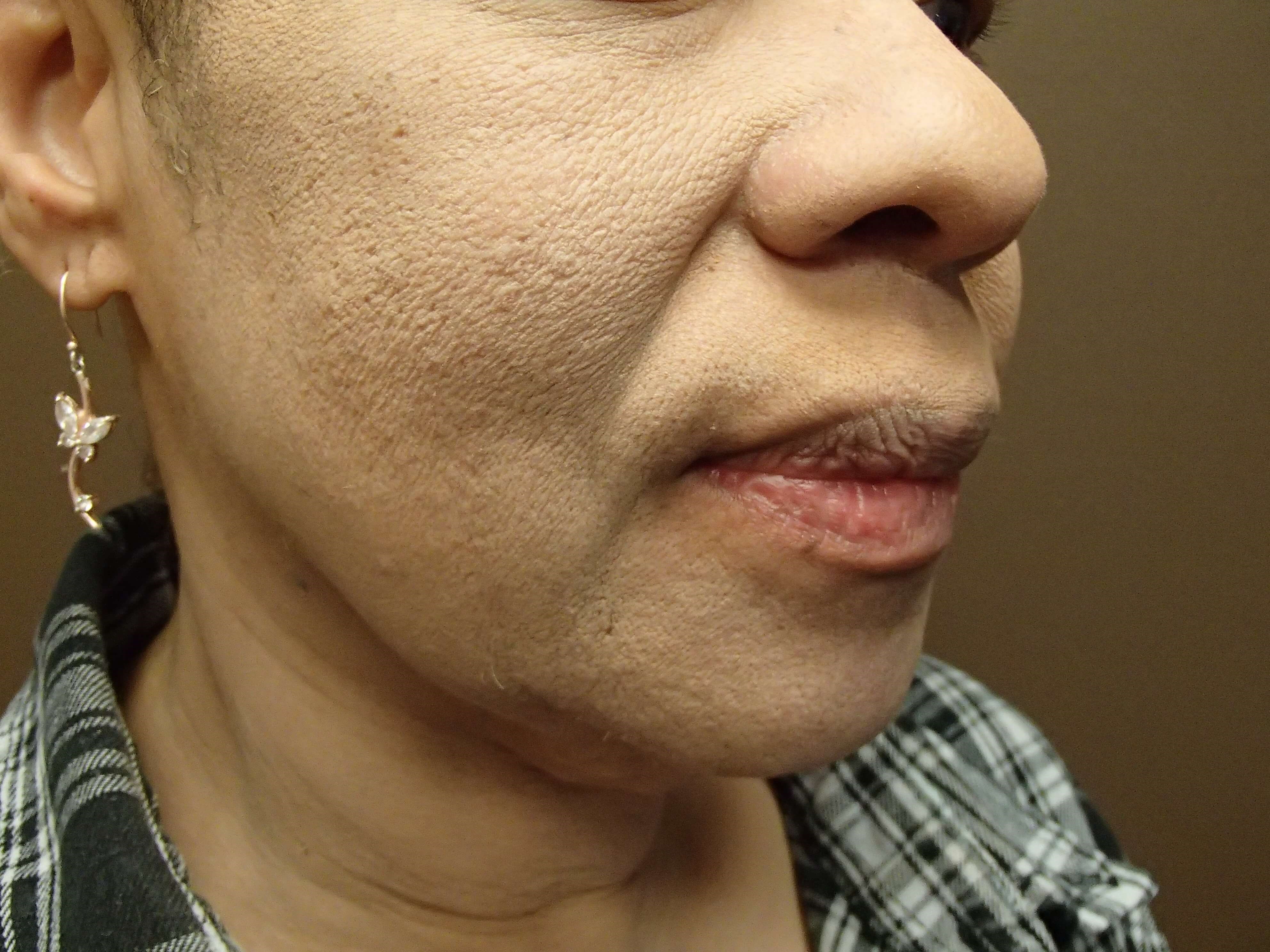 Facelift Before