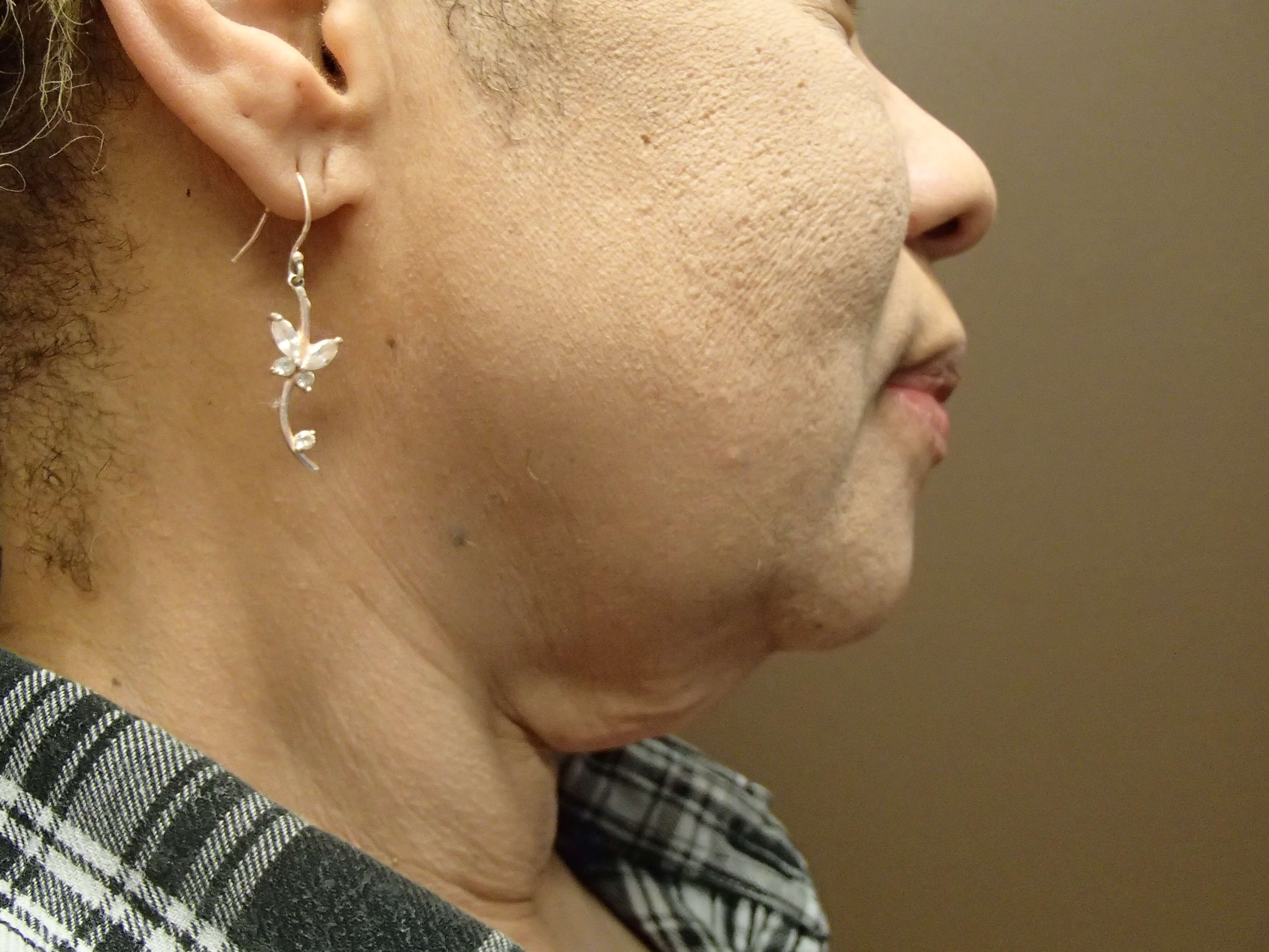 Facelift Before