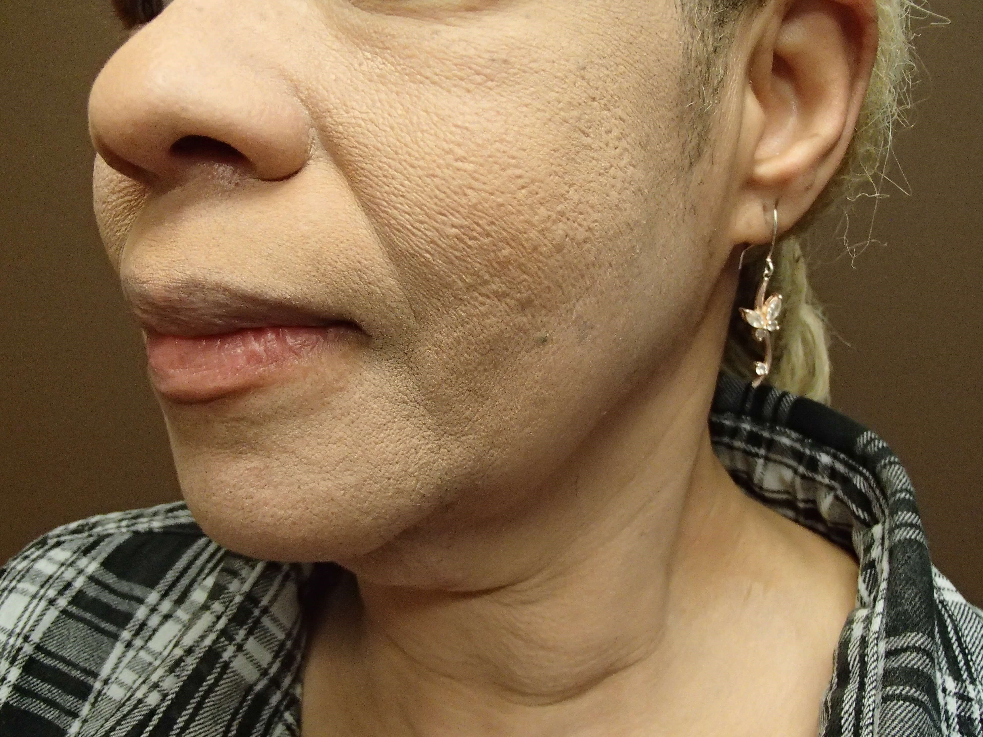 Facelift Before